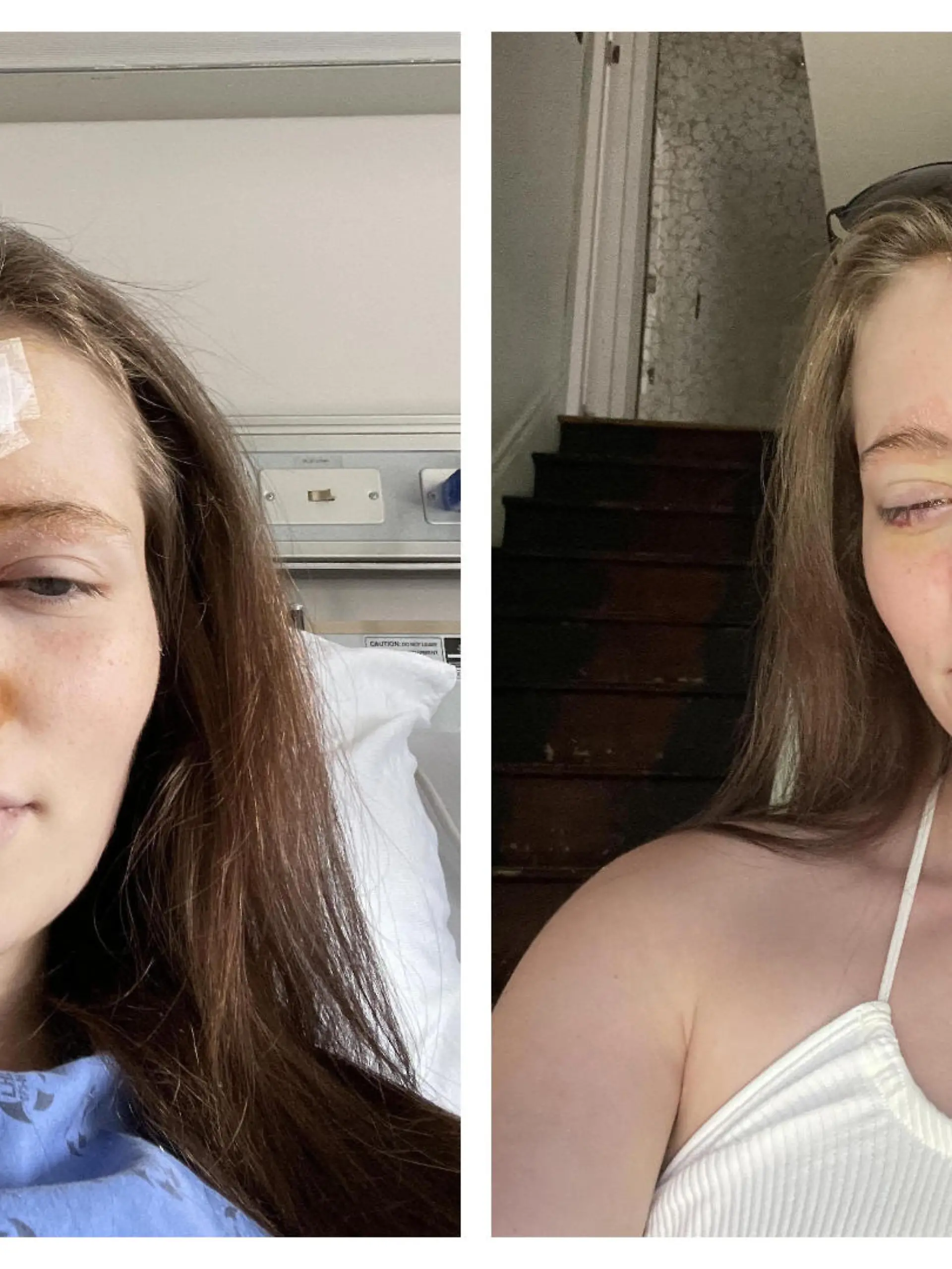 Taiva Finlayson nach ihrer Augenoperation.