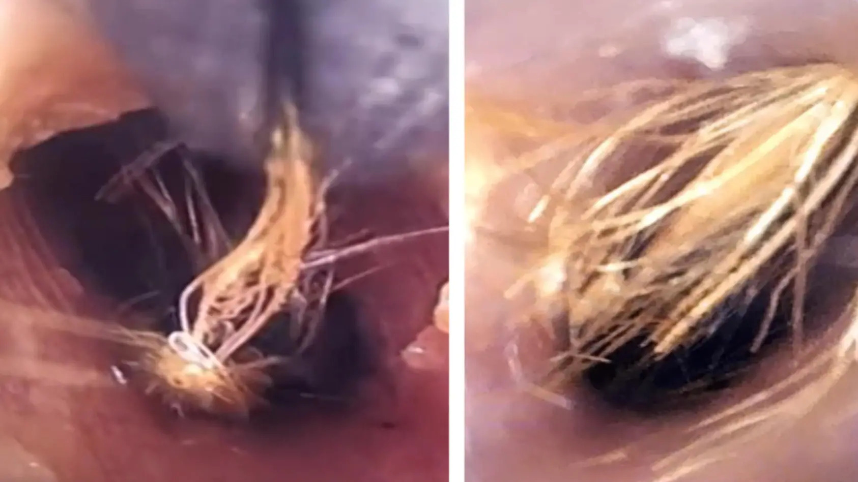 Arzt entfernt Pflanze aus Ohr