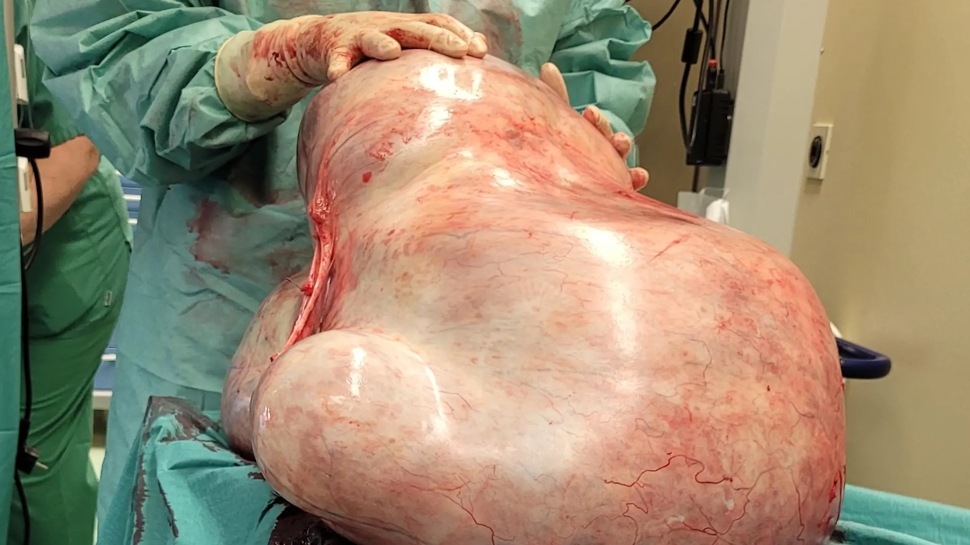 HANDOUT - 20.11.2023, Sachsen-Anhalt, Magdeburg: Ein 32 Kilogramm schwerer Tumor. der einer jungen Frau entfernt wurde, liegt in einem Raum der Universitätsklinik. Die gutartige Geschwulst, ein sogenanntes Zystadenom, hatte sich nach Klinikangaben über längere Zeit unbemerkt entwickelt. (Zu dpa: «32 Kilogramm schwerer Tumor bei Frau in Magdeburg entfernt») Foto: -/Universitätsfrauenklinik Magdeburg/dpa - ACHTUNG: Nur zur redaktionellen Verwendung im Zusammenhang mit der aktuellen Berichterstattung und nur mit vollständiger Nennung des vorstehenden Credits +++ dpa-Bildfunk +++
