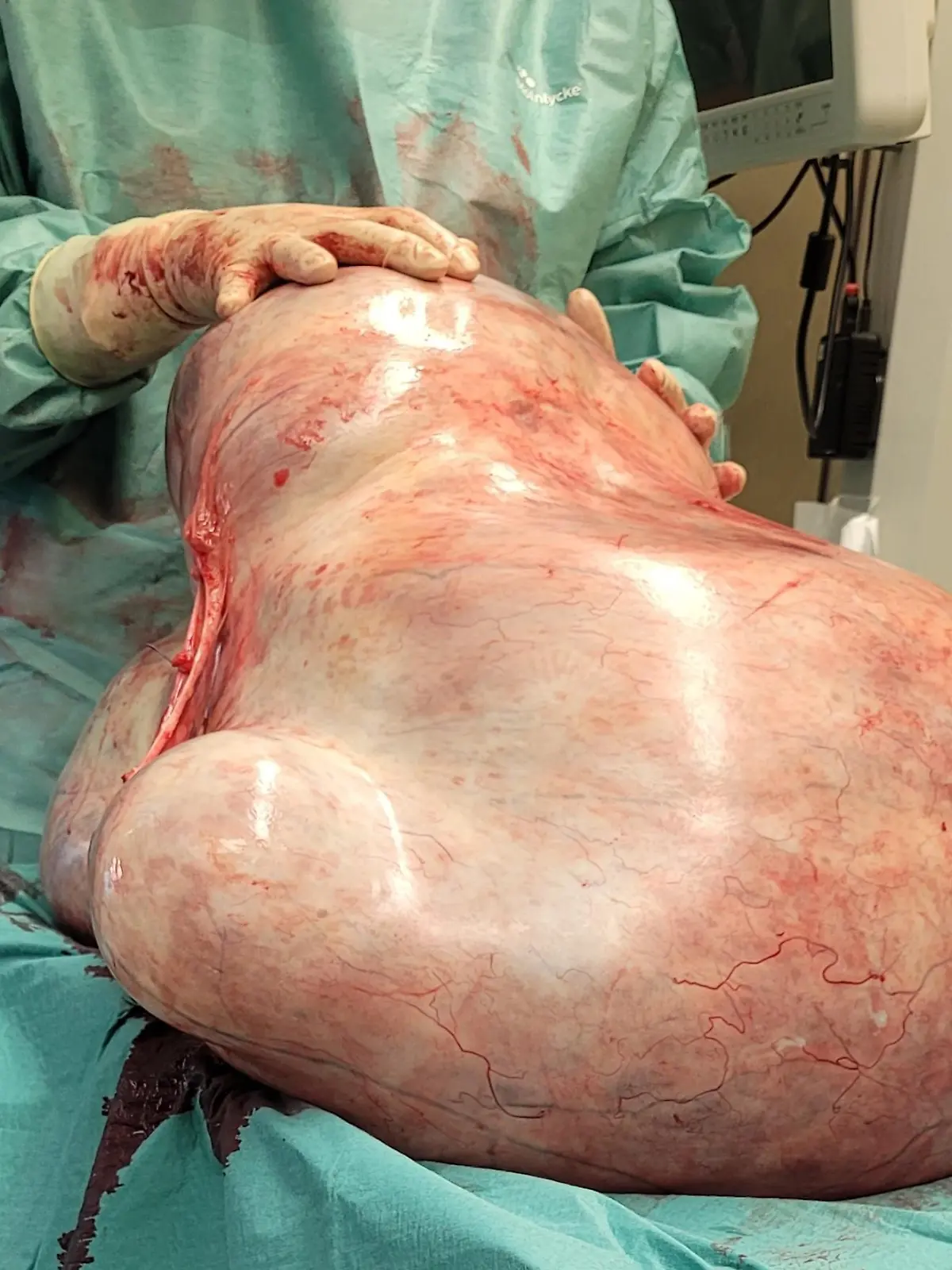 HANDOUT - 20.11.2023, Sachsen-Anhalt, Magdeburg: Ein 32 Kilogramm schwerer Tumor. der einer jungen Frau entfernt wurde, liegt in einem Raum der Universitätsklinik. Die gutartige Geschwulst, ein sogenanntes Zystadenom, hatte sich nach Klinikangaben über längere Zeit unbemerkt entwickelt. (Zu dpa: «32 Kilogramm schwerer Tumor bei Frau in Magdeburg entfernt») Foto: -/Universitätsfrauenklinik Magdeburg/dpa - ACHTUNG: Nur zur redaktionellen Verwendung im Zusammenhang mit der aktuellen Berichterstattung und nur mit vollständiger Nennung des vorstehenden Credits +++ dpa-Bildfunk +++