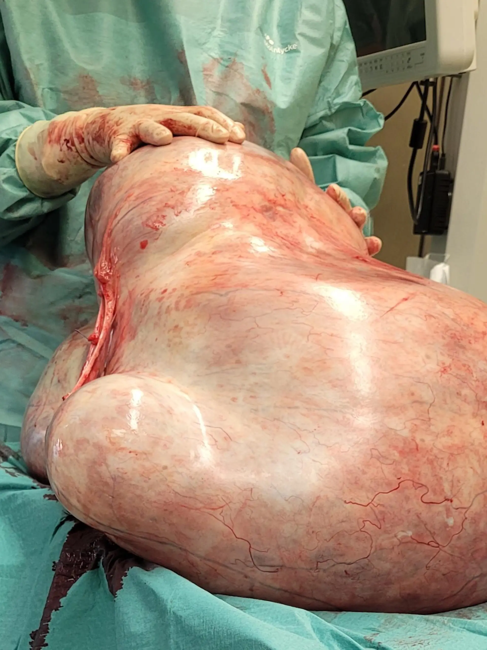 HANDOUT - 20.11.2023, Sachsen-Anhalt, Magdeburg: Ein 32 Kilogramm schwerer Tumor. der einer jungen Frau entfernt wurde, liegt in einem Raum der Universitätsklinik. Die gutartige Geschwulst, ein sogenanntes Zystadenom, hatte sich nach Klinikangaben über längere Zeit unbemerkt entwickelt. (Zu dpa: «32 Kilogramm schwerer Tumor bei Frau in Magdeburg entfernt») Foto: -/Universitätsfrauenklinik Magdeburg/dpa - ACHTUNG: Nur zur redaktionellen Verwendung im Zusammenhang mit der aktuellen Berichterstattung und nur mit vollständiger Nennung des vorstehenden Credits +++ dpa-Bildfunk +++
