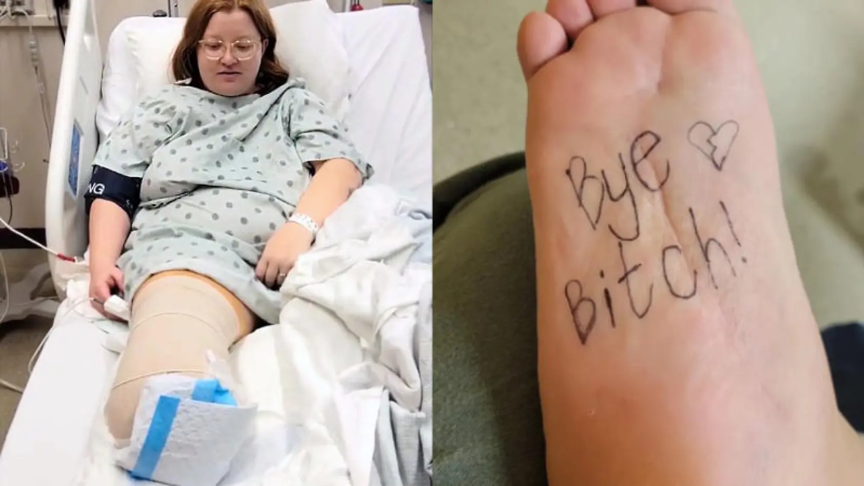 Sierra (28) ließ sich freiwillig den Fuß amputieren