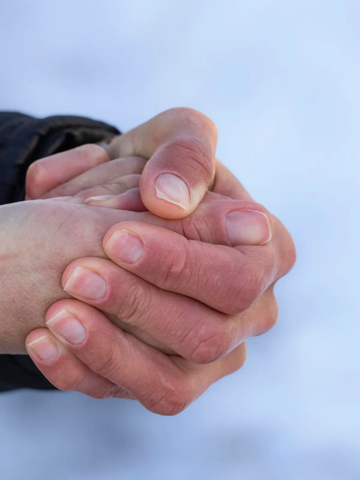 Red hands in the cold.Risk of frostbite of hand or fingers outdoors during cold weather because of frost in winter.
