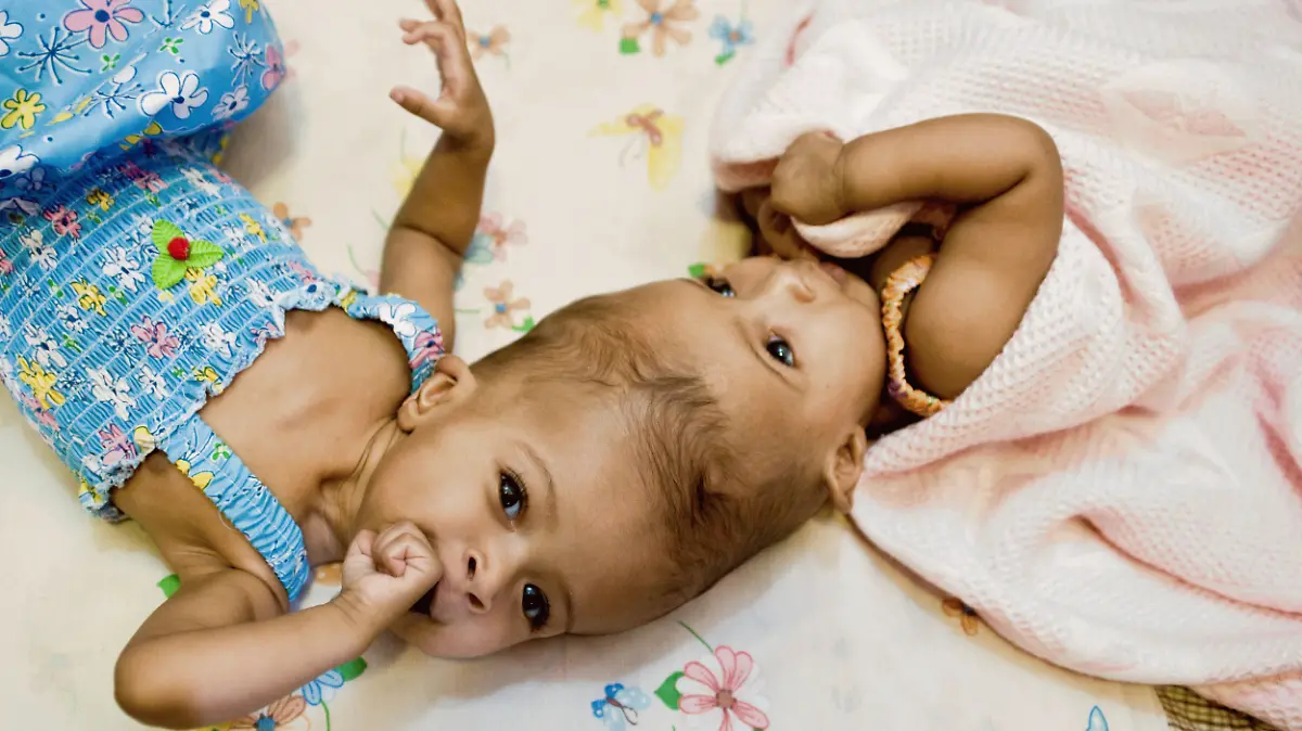 Rital and Ritag Gaboura - Sudanese born conjoined twins who were successfully separated at London's Ormond Street Hospital on 15/08/2011. They are craniopagus twins, meaning they were born joined at the head. The 11-month-old girls were flown to Britain with the help of the Facing the World organisation. The twins' parents, Abdelmajeed and Enas Gaboura, said in a statement: "We are very thankful to be able to look forward to going home with two separate, healthy girls".