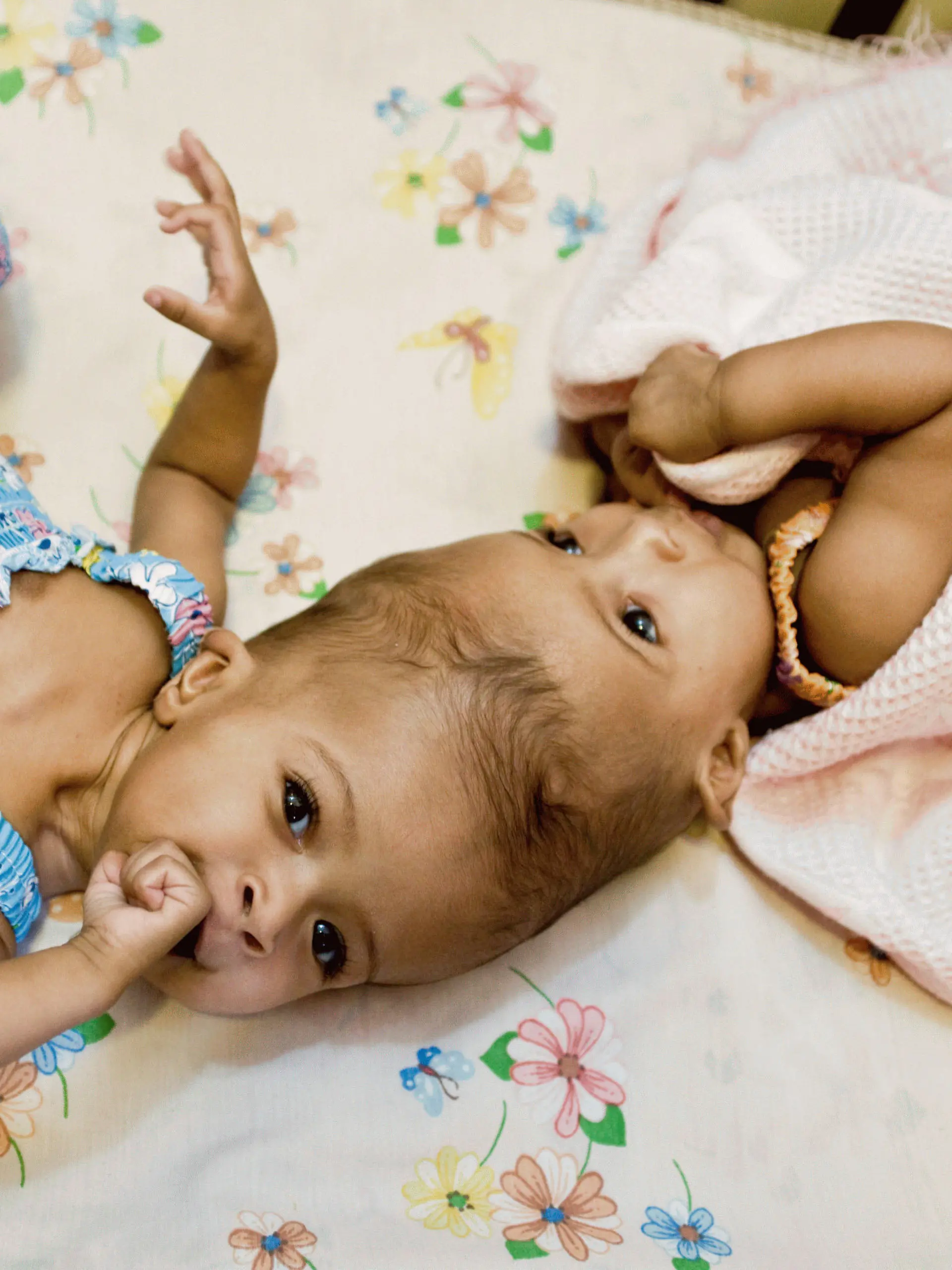 Rital and Ritag Gaboura - Sudanese born conjoined twins who were successfully separated at London's Ormond Street Hospital on 15/08/2011. They are craniopagus twins, meaning they were born joined at the head. The 11-month-old girls were flown to Britain with the help of the Facing the World organisation. The twins' parents, Abdelmajeed and Enas Gaboura, said in a statement: "We are very thankful to be able to look forward to going home with two separate, healthy girls".

