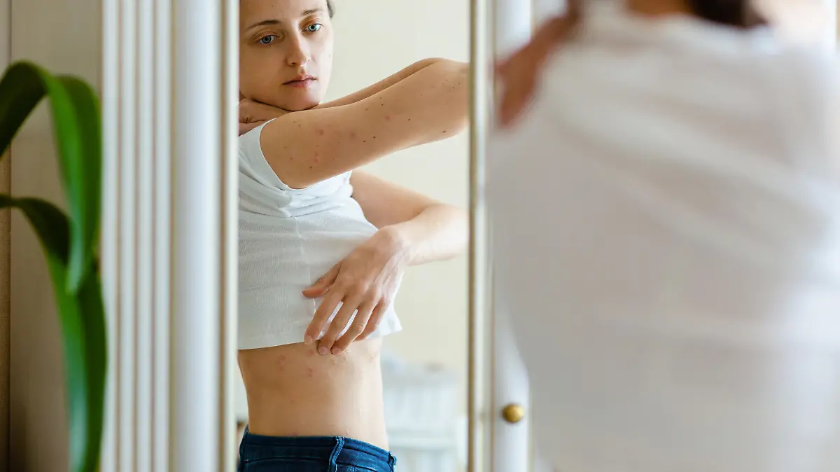 Woman looks in to a mirror an itching rash on dry flaky skin, as in the psoriasis, eczema and other diseases