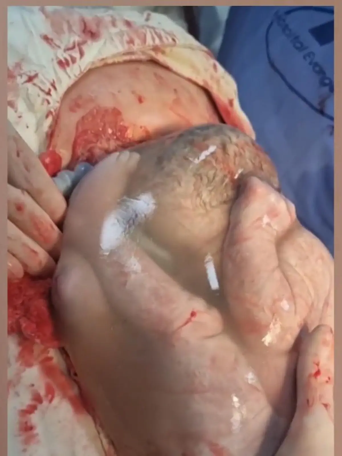 Diese Geburt ist etwas wirklich ganz Besonderes. Die Fruchtblase des Babys platzt nicht - das Kind kommt in der Glückshaube zur Welt.