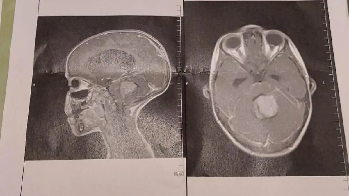 Der Scan zeigt, wie groß der Tumor war, als er erkannt wurde