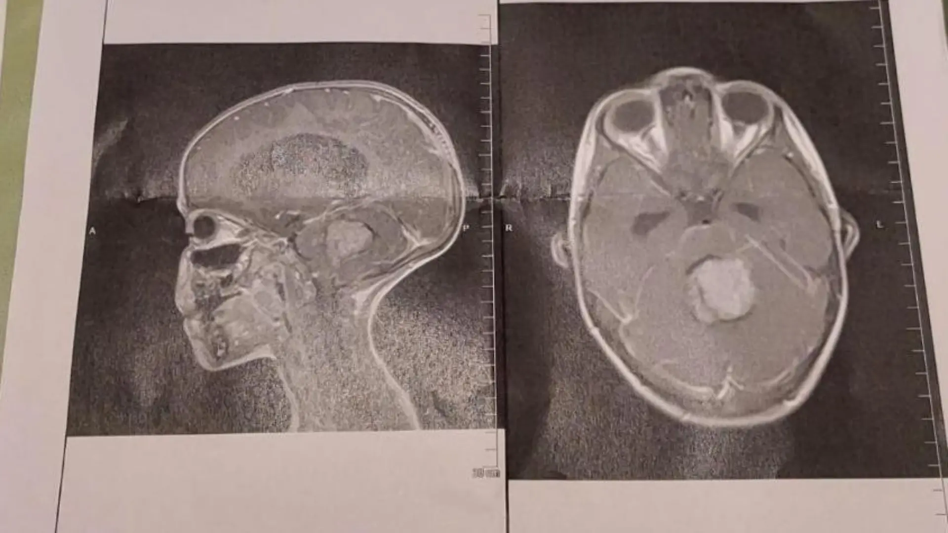 Der Scan zeigt, wie groß der Tumor war, als er erkannt wurde
