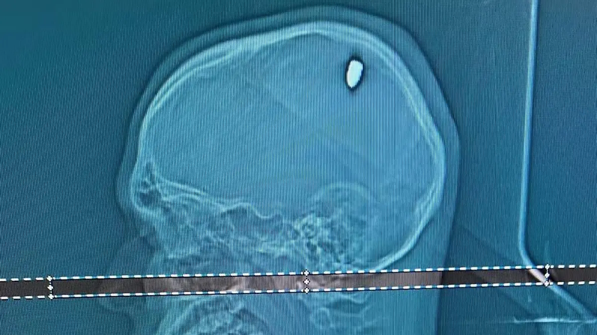 Story from Jam Press (Lad Bullet Head) 

Pictured: Mateus Facio’s X-ray showing the bullet in his head.

Man who thought he was hit by a stone found out four days later that he had a bullet in his head

A young man who thought someone had chucked a stone at him found out four days later he had a bullet lodged in his head.

Mateus Facio was having fun with his pals on the beach when he felt something hit him.

The 21-year-old said: “I thought it was a bad joke.

“Like someone had picked up and thrown a stone. Because I didn’t hear anything.

“If I’d heard a noise, I might have suspected something.”

“But I didn’t hear anything, everything seemed perfectly normal.” he told local media.

Mateus continued enjoying the beach in Cabo Frio, east of Rio de Janeiro, Brazil.

But after returning home to Juiz de Fora, his arms and fingers stopped moving normally and he ended up going to hospital for tests.

He was stunned when medics told him he had a 9mm bullet lodged in his head.

Mateus had an operation to remove the projectile.

Neurosurgeon Flávio Falcometa told local media: “The bullet was compressing the brain in an area close to the region responsible for the movement of the right arm, causing irritation.

“This led to the brain to respond with movements that manifested as convulsive episodes.

“It was in an area very close to what we call the motor area of the brain, which is responsible for movement.

“The bullet could have caused much more serious damage, potentially leaving his arm or half of his body paralysed.”

The removed bullet was sent to the police in Cabo Frio, who are investigating the case.

They say there were no reports of shootings in the area on that day.

Mateus spent two days in the ICU.

His mum, Luciana, recalled: “The doctor explained the situation, that Mateus would have to undergo surgery to remove the bullet, and he would run some risks, albeit minor.

“There were concerns about bleeding, leakage of cerebral 
