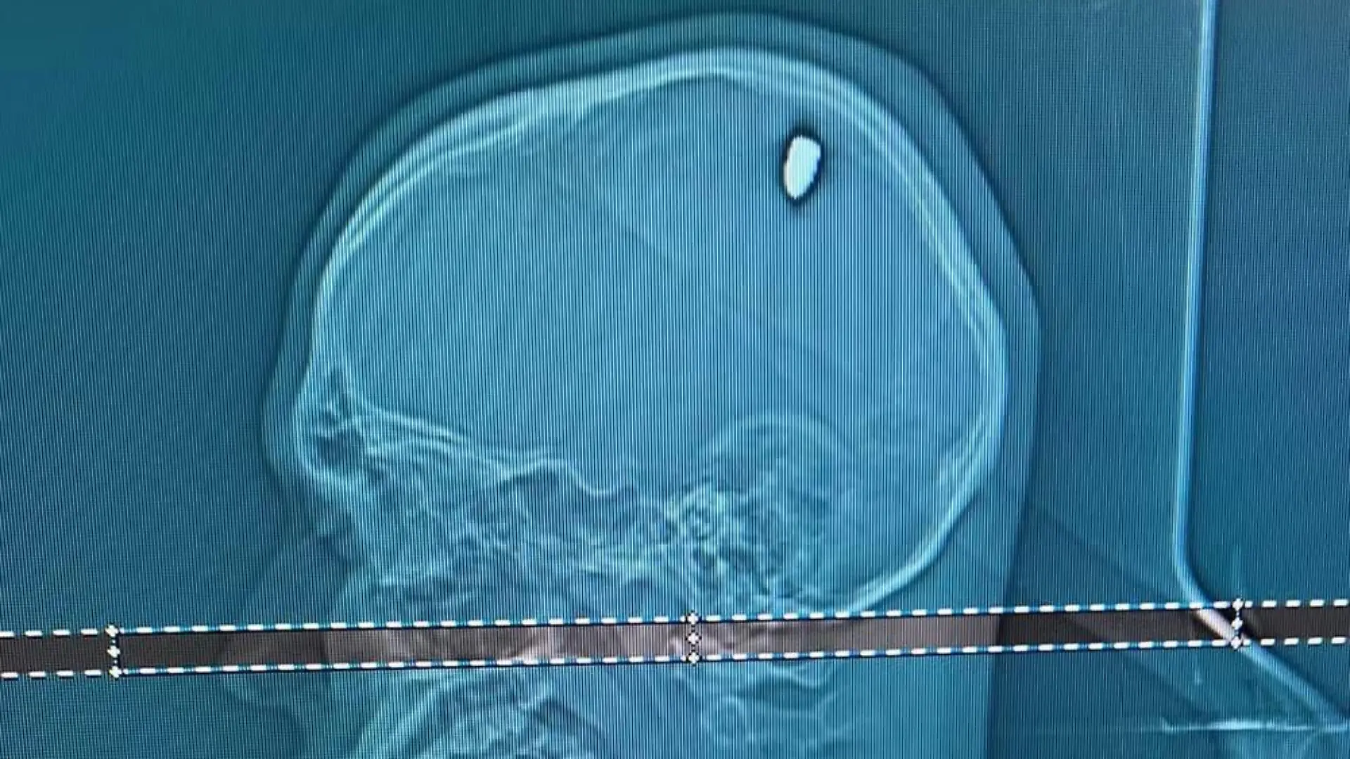 Story from Jam Press (Lad Bullet Head) 

Pictured: Mateus Facio’s X-ray showing the bullet in his head.

Man who thought he was hit by a stone found out four days later that he had a bullet in his head

A young man who thought someone had chucked a stone at him found out four days later he had a bullet lodged in his head.

Mateus Facio was having fun with his pals on the beach when he felt something hit him.

The 21-year-old said: “I thought it was a bad joke.

“Like someone had picked up and thrown a stone. Because I didn’t hear anything.

“If I’d heard a noise, I might have suspected something.”

“But I didn’t hear anything, everything seemed perfectly normal.” he told local media.

Mateus continued enjoying the beach in Cabo Frio, east of Rio de Janeiro, Brazil.

But after returning home to Juiz de Fora, his arms and fingers stopped moving normally and he ended up going to hospital for tests.

He was stunned when medics told him he had a 9mm bullet lodged in his head.

Mateus had an operation to remove the projectile.

Neurosurgeon Flávio Falcometa told local media: “The bullet was compressing the brain in an area close to the region responsible for the movement of the right arm, causing irritation.

“This led to the brain to respond with movements that manifested as convulsive episodes.

“It was in an area very close to what we call the motor area of the brain, which is responsible for movement.

“The bullet could have caused much more serious damage, potentially leaving his arm or half of his body paralysed.”

The removed bullet was sent to the police in Cabo Frio, who are investigating the case.

They say there were no reports of shootings in the area on that day.

Mateus spent two days in the ICU.

His mum, Luciana, recalled: “The doctor explained the situation, that Mateus would have to undergo surgery to remove the bullet, and he would run some risks, albeit minor.

“There were concerns about bleeding, leakage of cerebral 