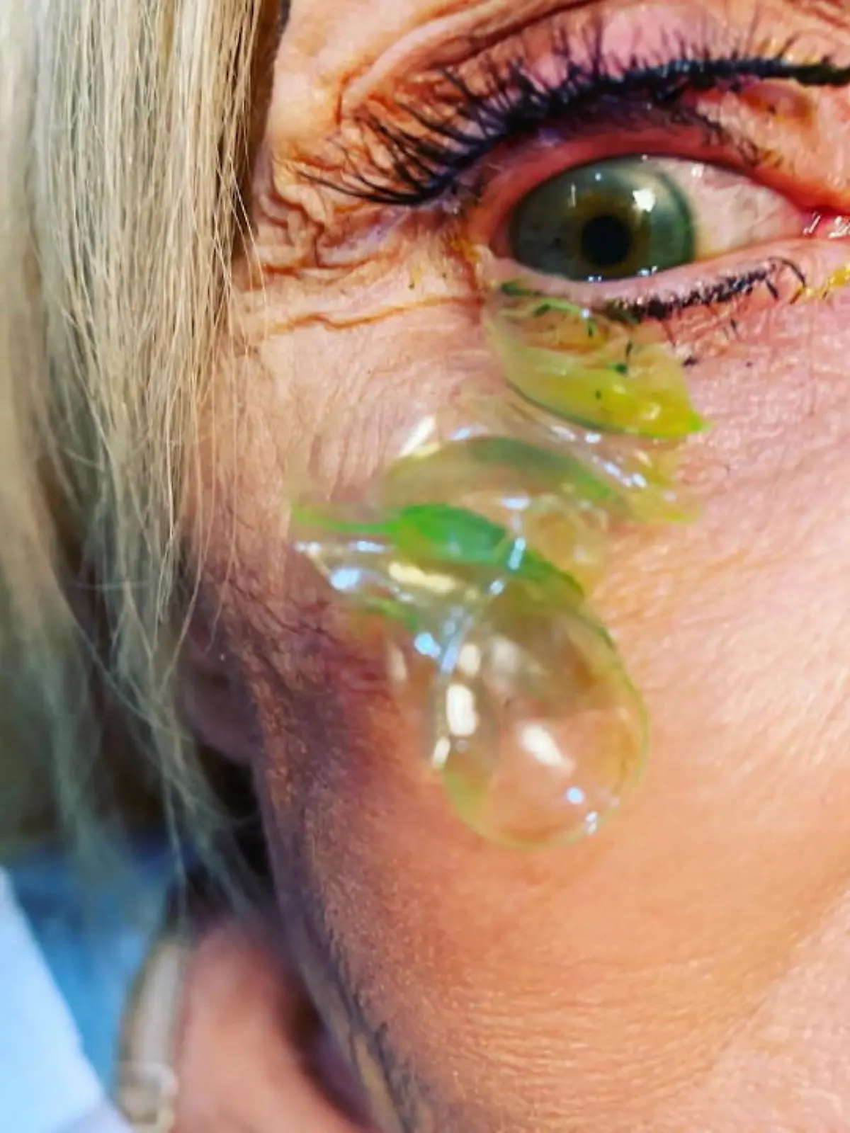 Das wäre fast ins Auge gegangen! Wegen starker Schmerzen und trockenen Augen ging eine Frau zum Augenarzt, der aus dem Staunen nicht mehr herauskam. Die Dame hatte insgesamt 23 Kontaktlinsen in einem Auge! Der Grund dafür? Sie hat Abends oft vergessen, die Linsen raus zu nehmen – und hat deshalb am nächsten Tag eine Neue eingesetzt. Ja, wirklich. Wie so etwas dann beim Augenarzt aussieht, erfahren Sie im Video.