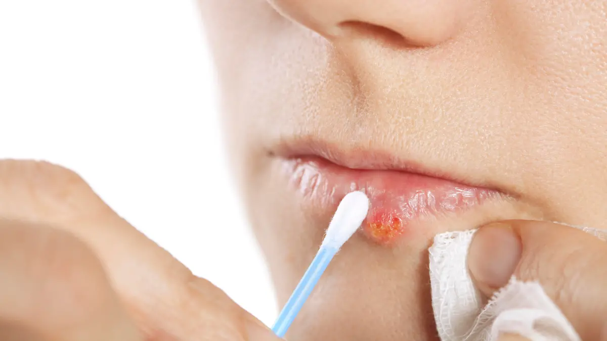 Herpes blister on the lip of a middle aged female.
