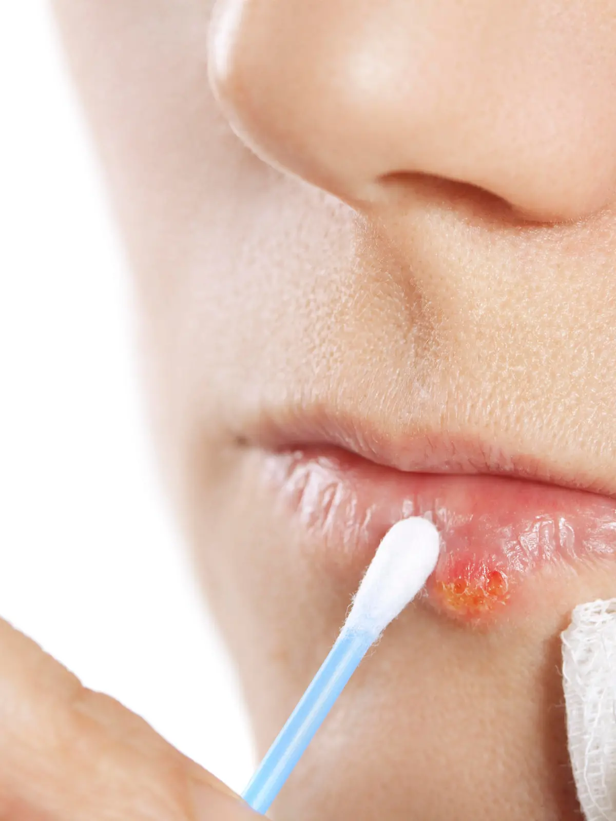 Herpes blister on the lip of a middle aged female.