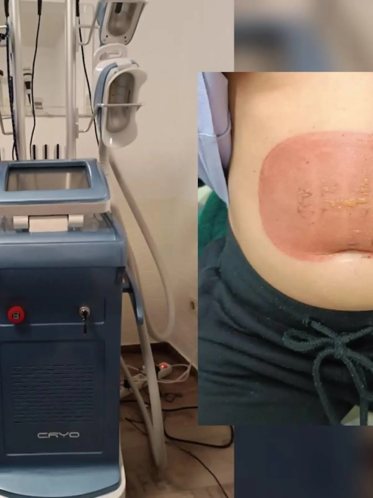 Das verspricht das Verfahren namens Kryolipolyse, bei dem Fettzellen mittels Kälte zum Schmelzen gebracht werden. Doch bei einer RTL-Zuschauerin geht ein solcher Eingriff gewaltig nach hinten los. Statt eines flachen Bauchs hat sie starke Verbrennungen, muss sogar ins Krankenhaus. Und der Anbieter? Der stellt sich tot! Als wir uns des Falls annehmen, kommen erschütternde Tatsachen ans Licht: Führt das betroffene Unternehmen besagten Eingriff ohne Erlaubnis und mit unzureichend geprüften Geräten durch? Wie der Fall ausgeht und worauf ihr dringend achten solltet, wenn auch ihr euch für eine Kryolipolyse-Behandlung interessiert, erfahrt ihr im Video.