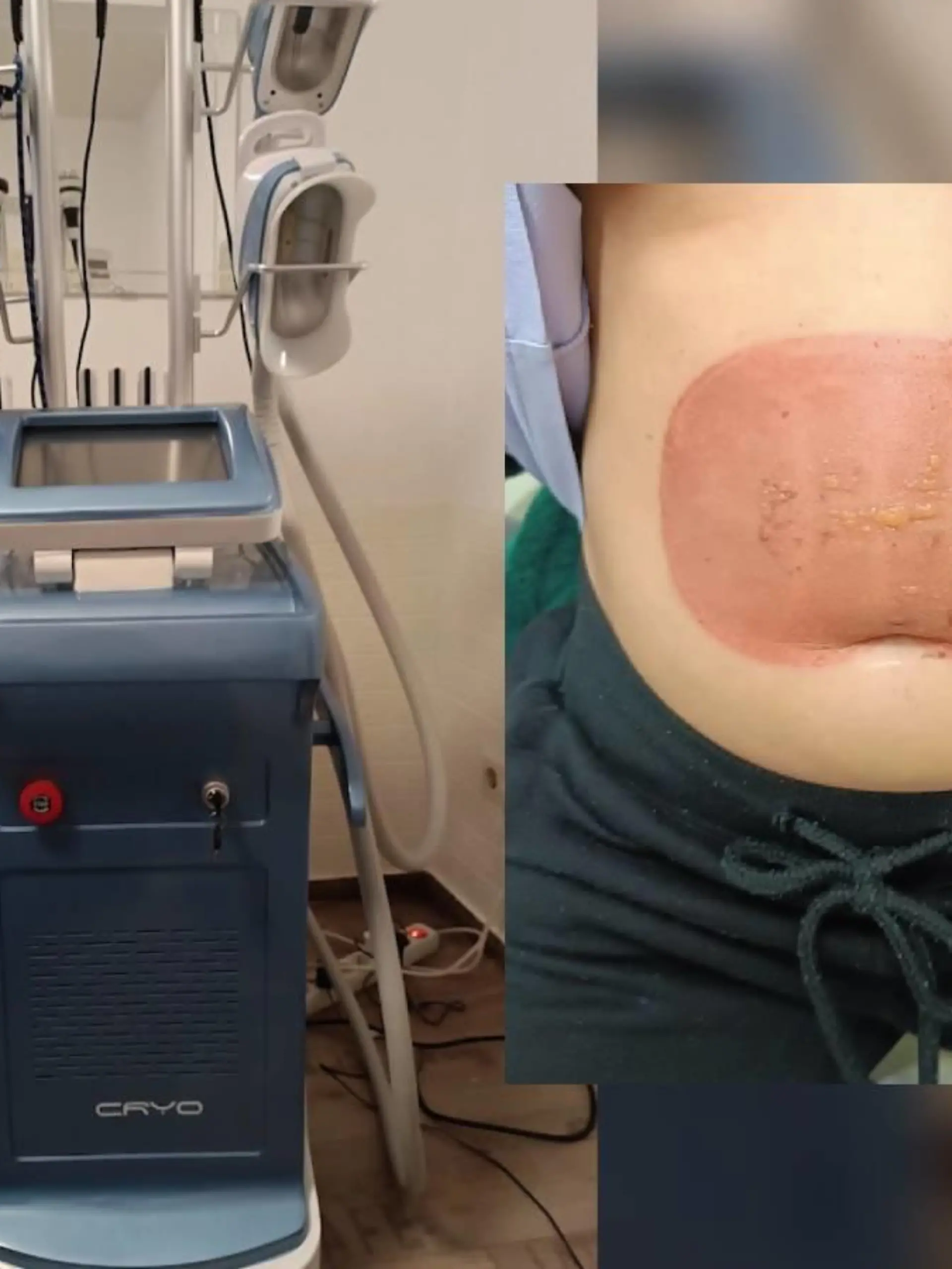 Das verspricht das Verfahren namens Kryolipolyse, bei dem Fettzellen mittels Kälte zum Schmelzen gebracht werden. Doch bei einer RTL-Zuschauerin geht ein solcher Eingriff gewaltig nach hinten los. Statt eines flachen Bauchs hat sie starke Verbrennungen, muss sogar ins Krankenhaus. Und der Anbieter? Der stellt sich tot! Als wir uns des Falls annehmen, kommen erschütternde Tatsachen ans Licht: Führt das betroffene Unternehmen besagten Eingriff ohne Erlaubnis und mit unzureichend geprüften Geräten durch? Wie der Fall ausgeht und worauf ihr dringend achten solltet, wenn auch ihr euch für eine Kryolipolyse-Behandlung interessiert, erfahrt ihr im Video.