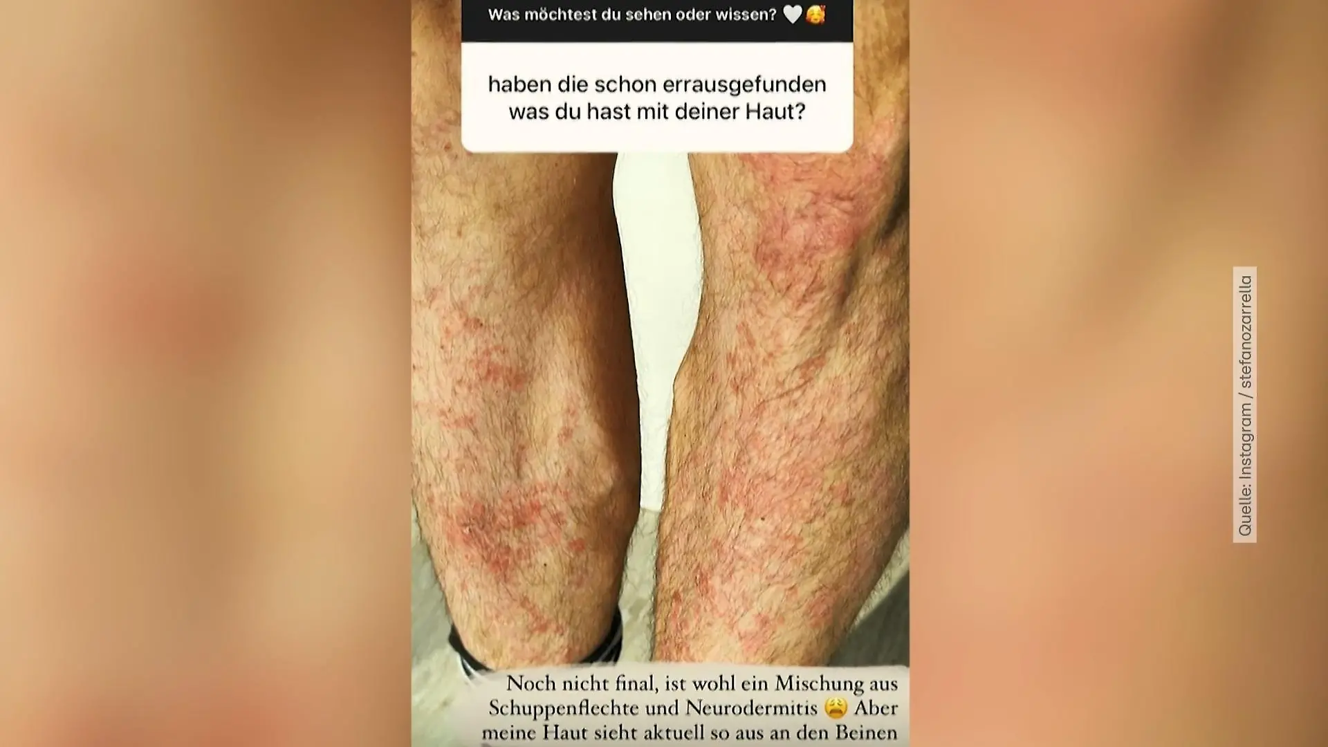 Stefano Zarrella zeigt Schuppenflechte