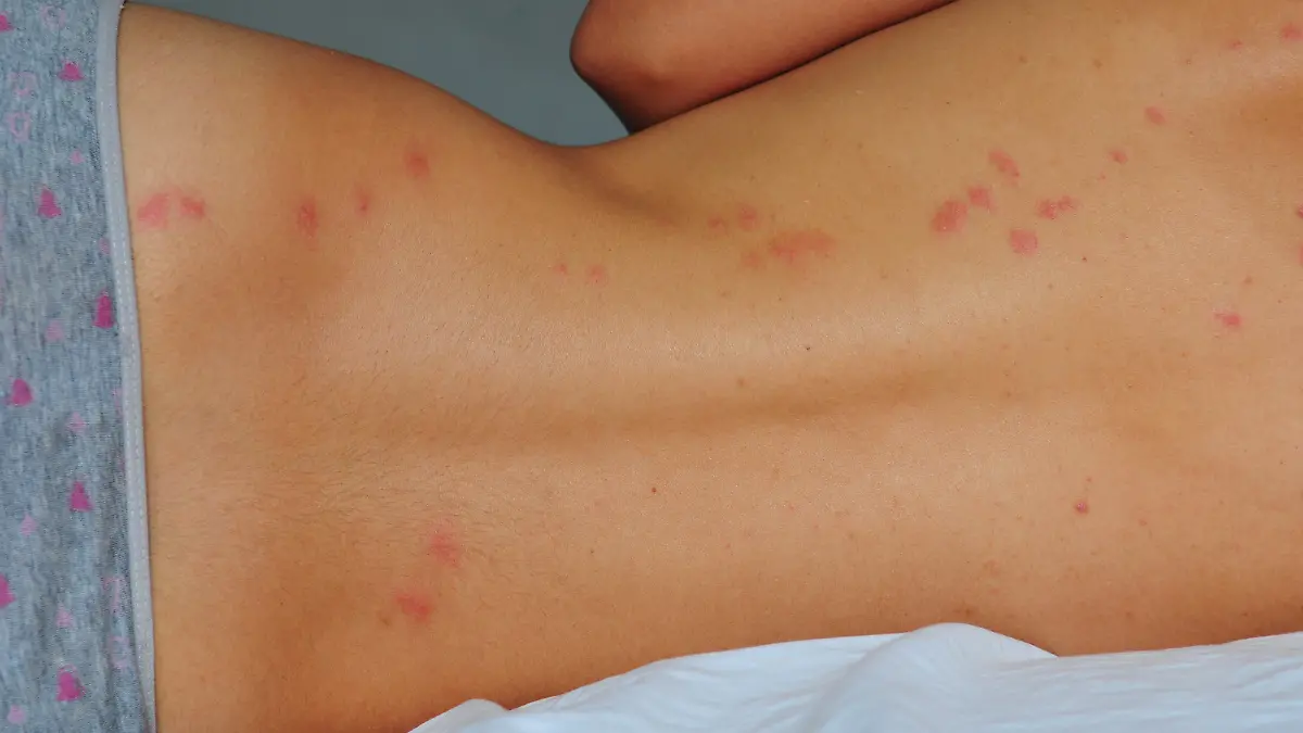 Two-day old lines of bedbug bites on a woman's back