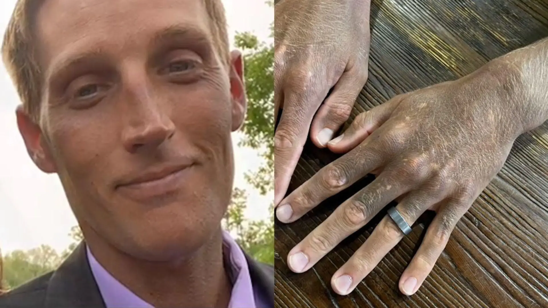 SONDERKONDITIONEN: Satzpreis! A man is a 'medical mystery' after a commonly prescribed anti-depressant drug has changed his skin colour from white to dark grey - SWSMskin
A man has the medical profession scratching their heads after a 'mystery' reaction to a commonly prescribed drug changed his skin colour from white - to dark grey.
Tyler Monk, 34, was prescribed an anti-depressant last year after consulting a doctor for his mental health.
But the treatment failed to help his mental health - but did change the colour of his skin.
Tyler was given Fluoxetine, a type of antidepressant known as a selective serotonin reuptake inhibitor (SSRI), that is commonly prescribed to treat depression.
He started taking the drug in May 2021, but within a week Tyler?s wife, Emily, 28, noticed that his skin colour was changing.
Tyler, a pest control field inspector, stopped the medication after only a few weeks as it wasn?t helping his mental health, but his skin continued to darken.
First, his ears started to change colour before it rapidly spread to his neck and his face - before effecting his arms and hands.
Tyler also experienced other symptoms such as extremely red, irritated eyes and his skin is now very sensitive to the sun and it feels like it has been burned.
He admits to being ?in denial? at first, but after speaking to two of his co-workers, Tyler accepted he was actually turning grey.
Tyler has visited several specialists near the couple's home in Kinder, Louisiana, USA, since the discolouration, but they have all been stumped.
Doctors have ruled out any serious diseases, poisoning and autoimmune conditions - but they still can't tell the monks what is causing the problems.
Tyler's dermatologist has now referred him for an appointment with a team of eight skin specialists, which is an exciting breakthrough in a seemingly unsolvable case.
Ahead of his visit with the specialists, Tyler is due to receive a CAT scan of his abdomen and new rounds of blood work.
He said: "First they thought it was photosensitivity, so I'm having a reaction to light, but I've been covering up and I'm still getting darker.
?I can?t get any answers from the specialists so we decided to post on TikTok. We thought that it couldn?t hurt to share online, so let's see if by some chance anyone else out there has had this happen or maybe has some answers for us.
?It?s mainly been supportive! People have made lots of jokes. But we joke a lot so we just laugh along with them!?
Tyler and Emily have two children, they wish to keep anonymous, who stay-at-home mum Emily schools.
She described that they have tried their best to keep their daughters educated without scaring them or making them worried about their beloved dad.
Emily said: "For me and the children, we just worry about his health.
?We really don?t mind the colour change as long as he?s healthy and okay with it. We support whatever he chooses to do about it."
Emily initially posted about Tyler to the social media app TikTok to raise awareness about this drug and warn others about the importance of knowing the side effects of what you are taking.
She has used her TikTok to discuss with people around the world who have suggestions on what it could be and where they could get help.
So far the couple have spent around $500 on Tyler?s medical care.
They are now facing a potentially huge hospital bill, as they don't have insurance or know how many tests will be needed to determine what is happening.
Emily has organised a GoFundMe page in the hopes of raising some money to cover medical costs, travel and any other expenses whilst they prioritise getting Tyler back to his old self.
You can donate here - https://gofund.me/4a860faf.
/ action press