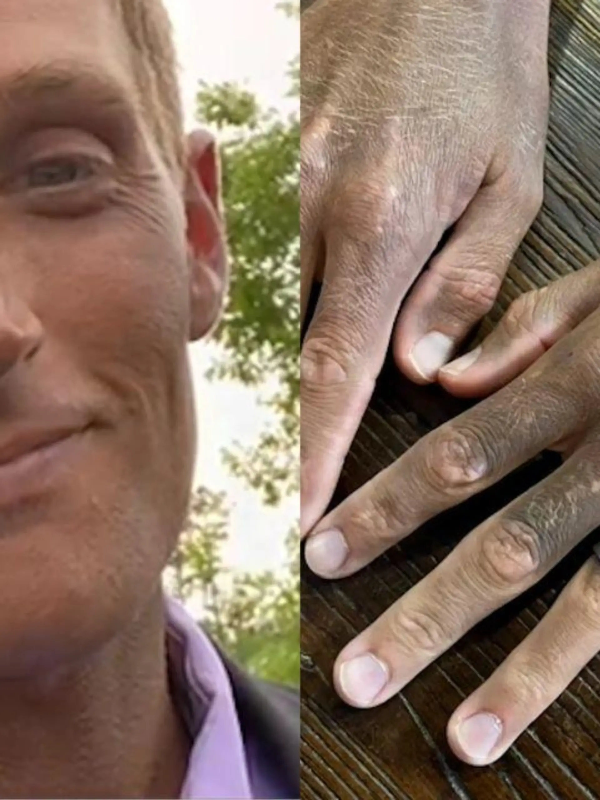 SONDERKONDITIONEN: Satzpreis!  A man is a 'medical mystery' after a commonly prescribed anti-depressant drug has changed his skin colour from white to dark grey - SWSMskin
A man has the medical profession scratching their heads after a 'mystery' reaction to a commonly prescribed drug changed his skin colour from white - to dark grey.
Tyler Monk, 34, was prescribed an anti-depressant last year after consulting a doctor for his mental health.
But the treatment failed to help his mental health - but did change the colour of his skin.
Tyler was given Fluoxetine, a type of antidepressant known as a selective serotonin reuptake inhibitor (SSRI), that is commonly prescribed to treat depression.
He started taking the drug in May 2021, but within a week Tyler?s wife, Emily, 28, noticed that his skin colour was changing.
Tyler, a pest control field inspector, stopped the medication after only a few weeks as it wasn?t helping his mental health, but his skin continued to darken.
First, his ears started to change colour before it rapidly spread to his neck and his face - before effecting his arms and hands.
Tyler also experienced other symptoms such as extremely red, irritated eyes and his skin is now very sensitive to the sun and it feels like it has been burned.
He admits to being ?in denial? at first, but after speaking to two of his co-workers, Tyler accepted he was actually turning grey.
Tyler has visited several specialists near the couple's home in Kinder, Louisiana, USA, since the discolouration, but they have all been stumped.
Doctors have ruled out any serious diseases, poisoning and autoimmune conditions - but they still can't tell the monks what is causing the problems.
Tyler's dermatologist has now referred him for an appointment with a team of eight skin specialists, which is an exciting breakthrough in a seemingly unsolvable case.
Ahead of his visit with the specialists, Tyler is due to receive a CAT scan of his abdomen and new rounds of blood work.
He said: "First they thought it was photosensitivity, so I'm having a reaction to light, but I've been covering up and I'm still getting darker.
?I can?t get any answers from the specialists so we decided to post on TikTok. We thought that it couldn?t hurt to share online, so let's see if by some chance anyone else out there has had this happen or maybe has some answers for us.
?It?s mainly been supportive! People have made lots of jokes. But we joke a lot so we just laugh along with them!?
Tyler and Emily have two children, they wish to keep anonymous, who stay-at-home mum Emily schools.
She described that they have tried their best to keep their daughters educated without scaring them or making them worried about their beloved dad.
Emily said: "For me and the children, we just worry about his health.
?We really don?t mind the colour change as long as he?s healthy and okay with it. We support whatever he chooses to do about it."
Emily initially posted about Tyler to the social media app TikTok to raise awareness about this drug and warn others about the importance of knowing the side effects of what you are taking.
She has used her TikTok to discuss with people around the world who have suggestions on what it could be and where they could get help.
So far the couple have spent around $500 on Tyler?s medical care.
They are now facing a potentially huge hospital bill, as they don't have insurance or know how many tests will be needed to determine what is happening.
Emily has organised a GoFundMe page in the hopes of raising some money to cover medical costs, travel and any other expenses whilst they prioritise getting Tyler back to his old self.

You can donate here - https://gofund.me/4a860faf.
 / action press