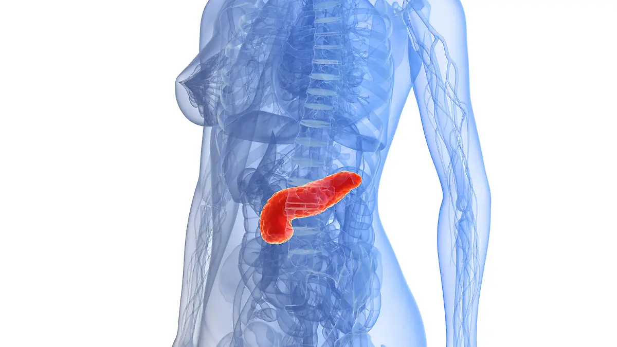 Bei einer akuten Bauchspeichendrüsenentzündung stauen meist Gallensteine den Pankreassaft, so dass die gestauten Enzyme das eigene Organ zerstören.