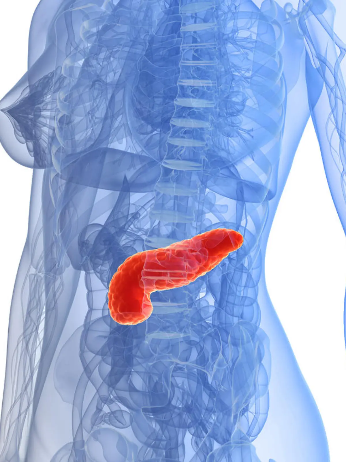 Bei einer akuten Bauchspeichendrüsenentzündung stauen meist Gallensteine den Pankreassaft, so dass die gestauten Enzyme das eigene Organ zerstören.