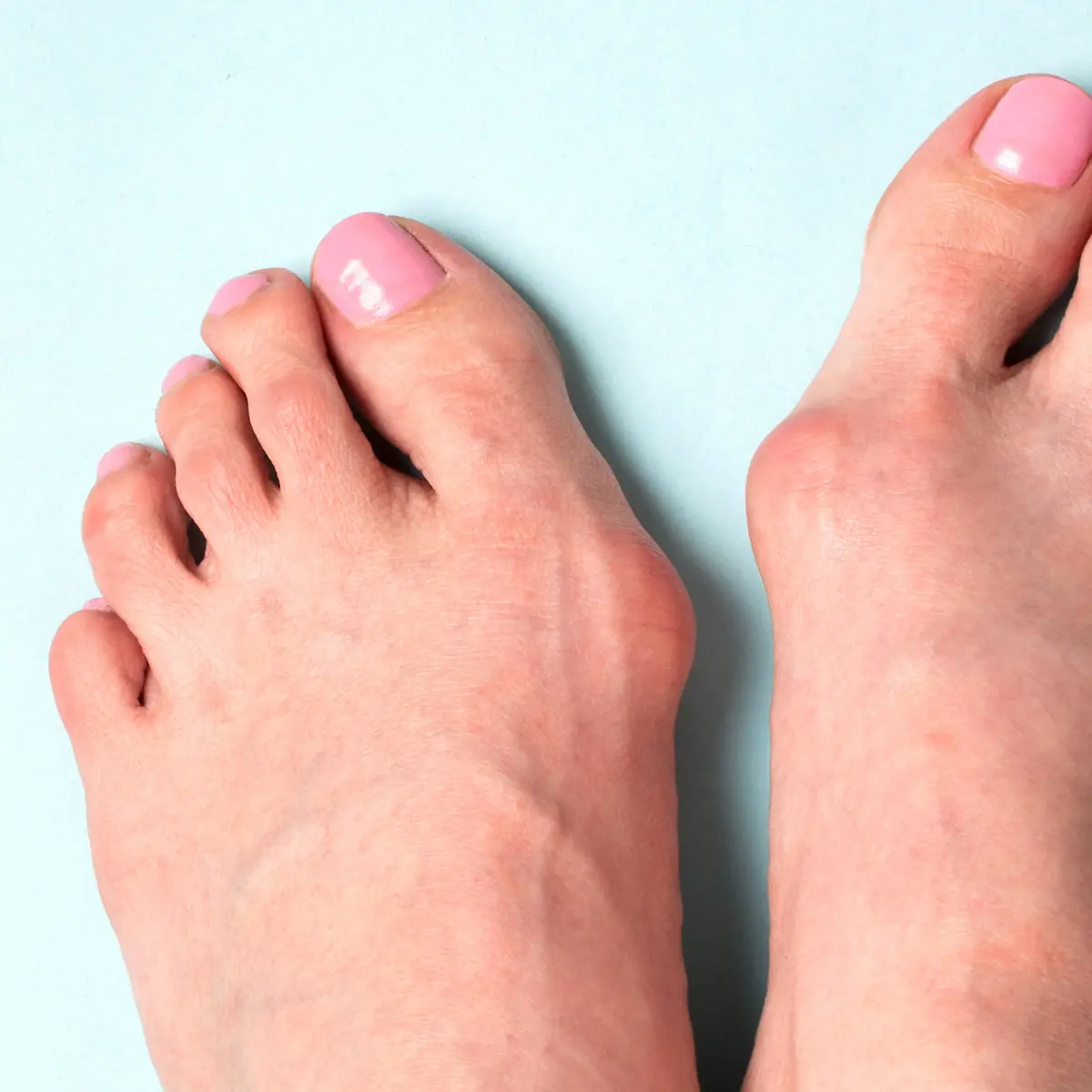 Hallux valgus Logo von Hallux valgus