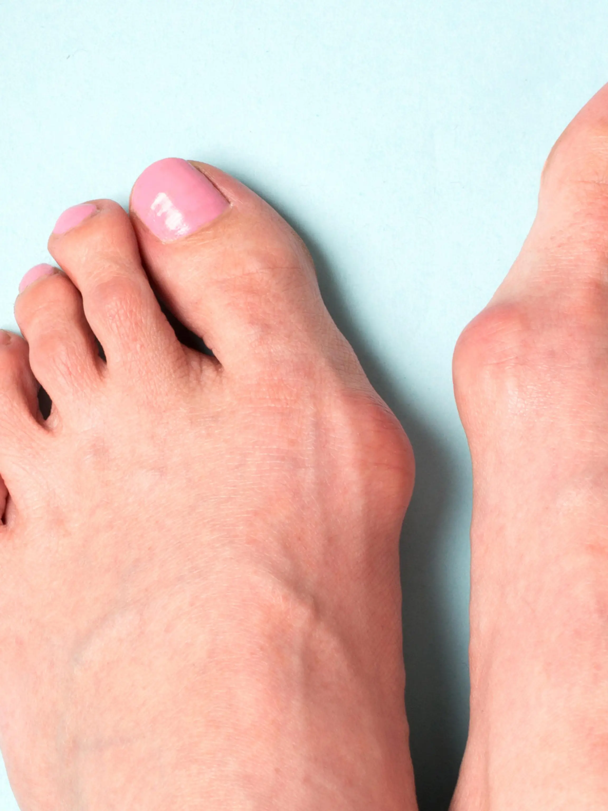 Ballenzeh Hallux Valgus