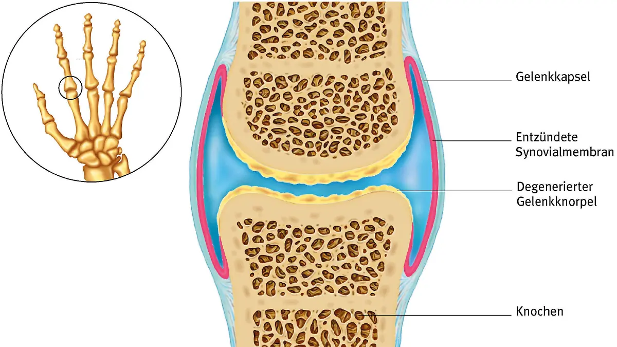 Die Illustration zeigt eine arthritisch erkranktes Gelenk.