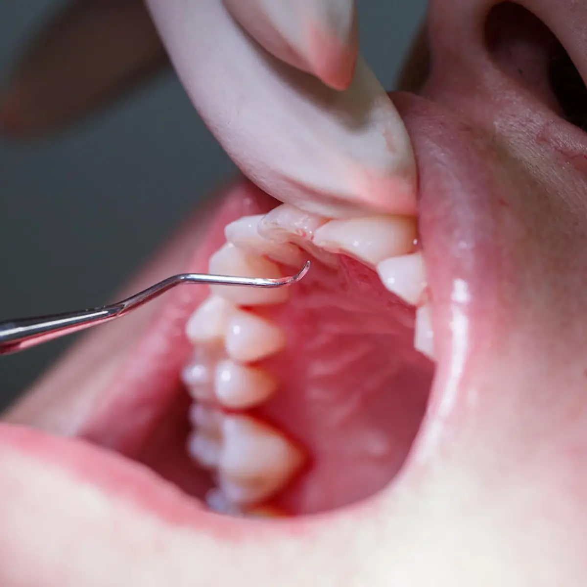 Zahnfleischentzündung (Gingivitis) Logo von Zahnfleischentzündung (Gingivitis)