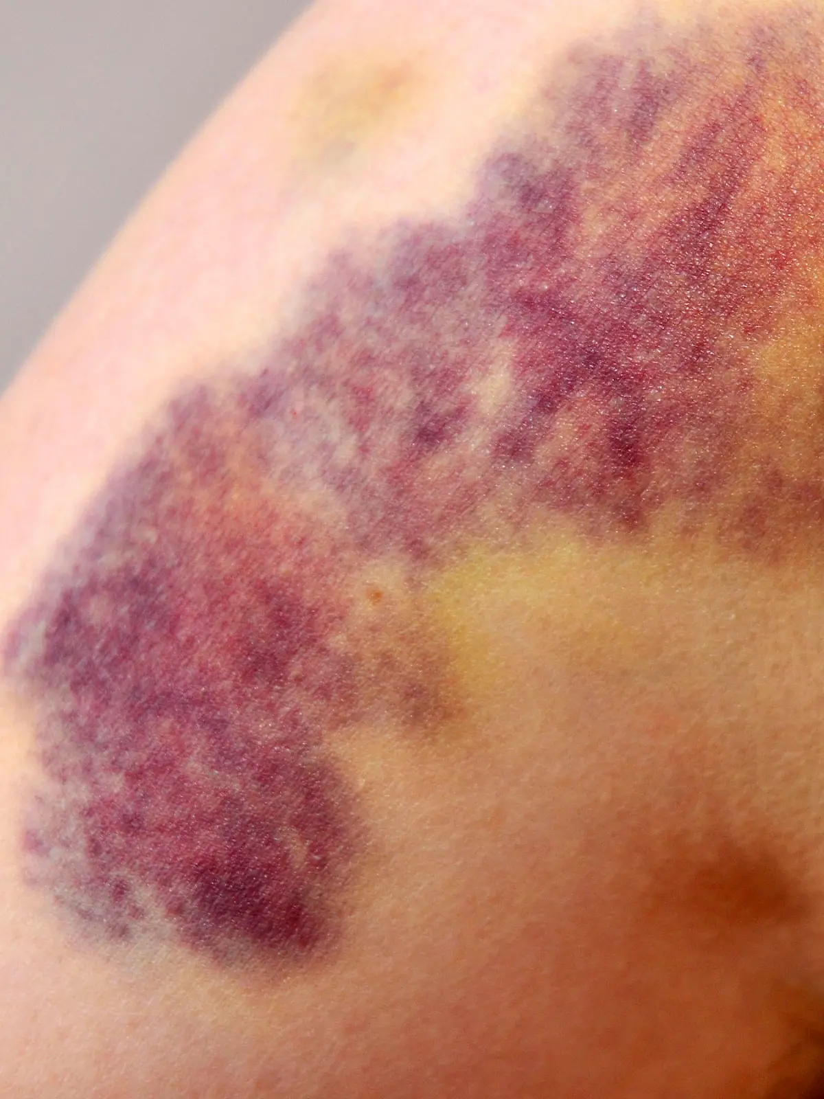 Haematom, Blauer Fleck, Bluterguss, haeusliche Gewalt / Hämatom, häusliche Gewalt