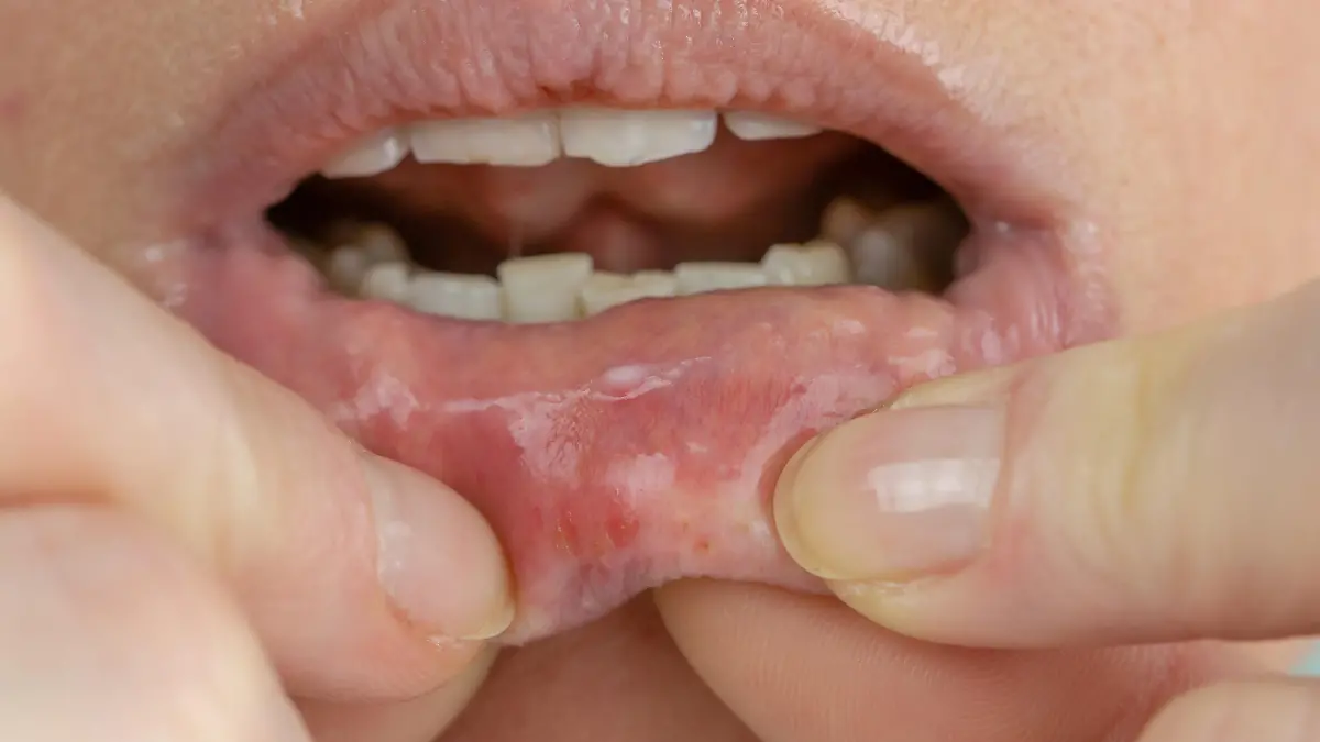 Gesundheitslexikon: Mundfäule (Stomatitis)