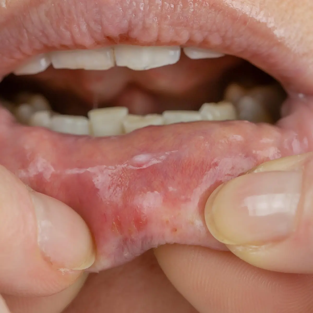 Stomatitis Logo von Stomatitis