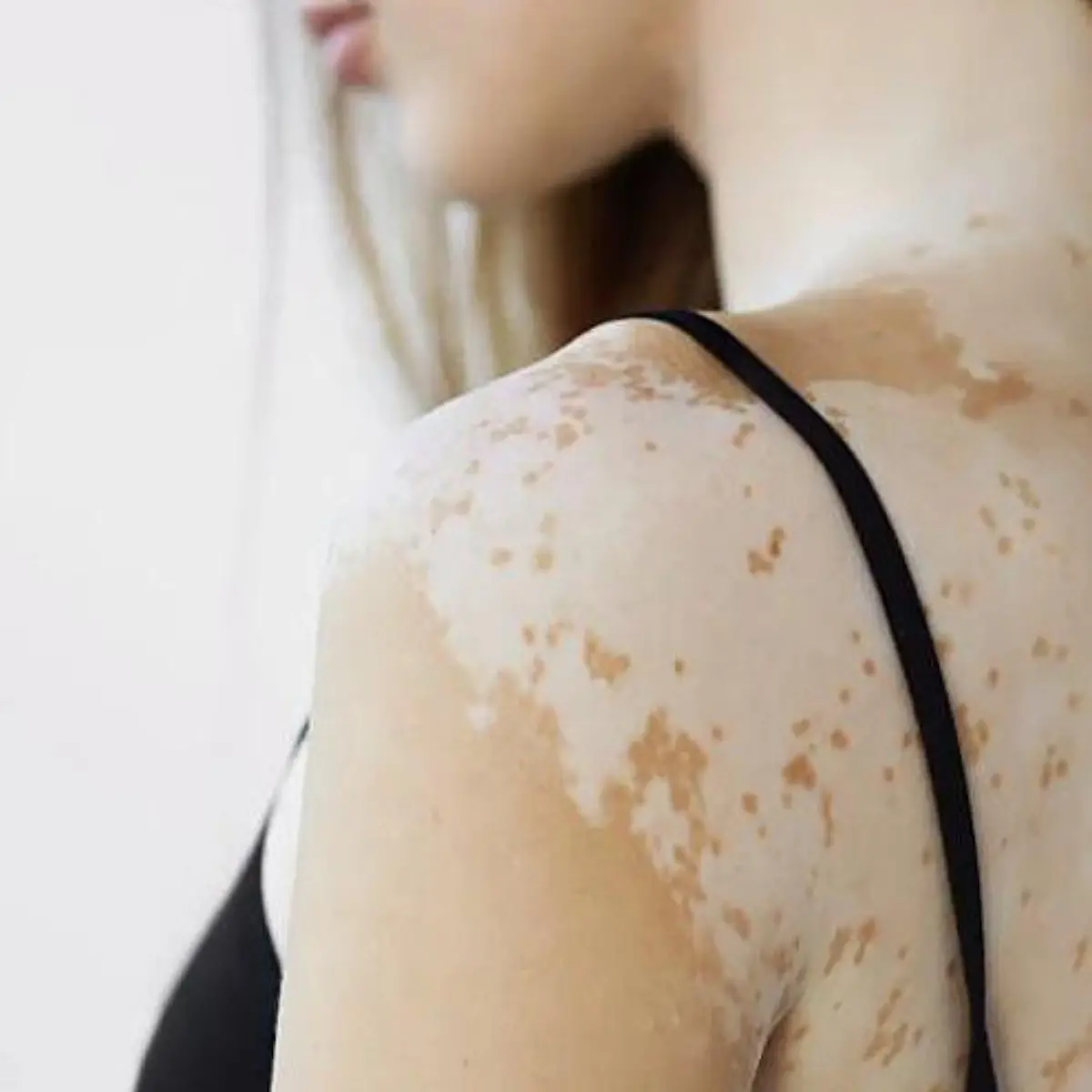 Vitiligo (Weißfleckenkrankheit) Logo von Vitiligo (Weißfleckenkrankheit)