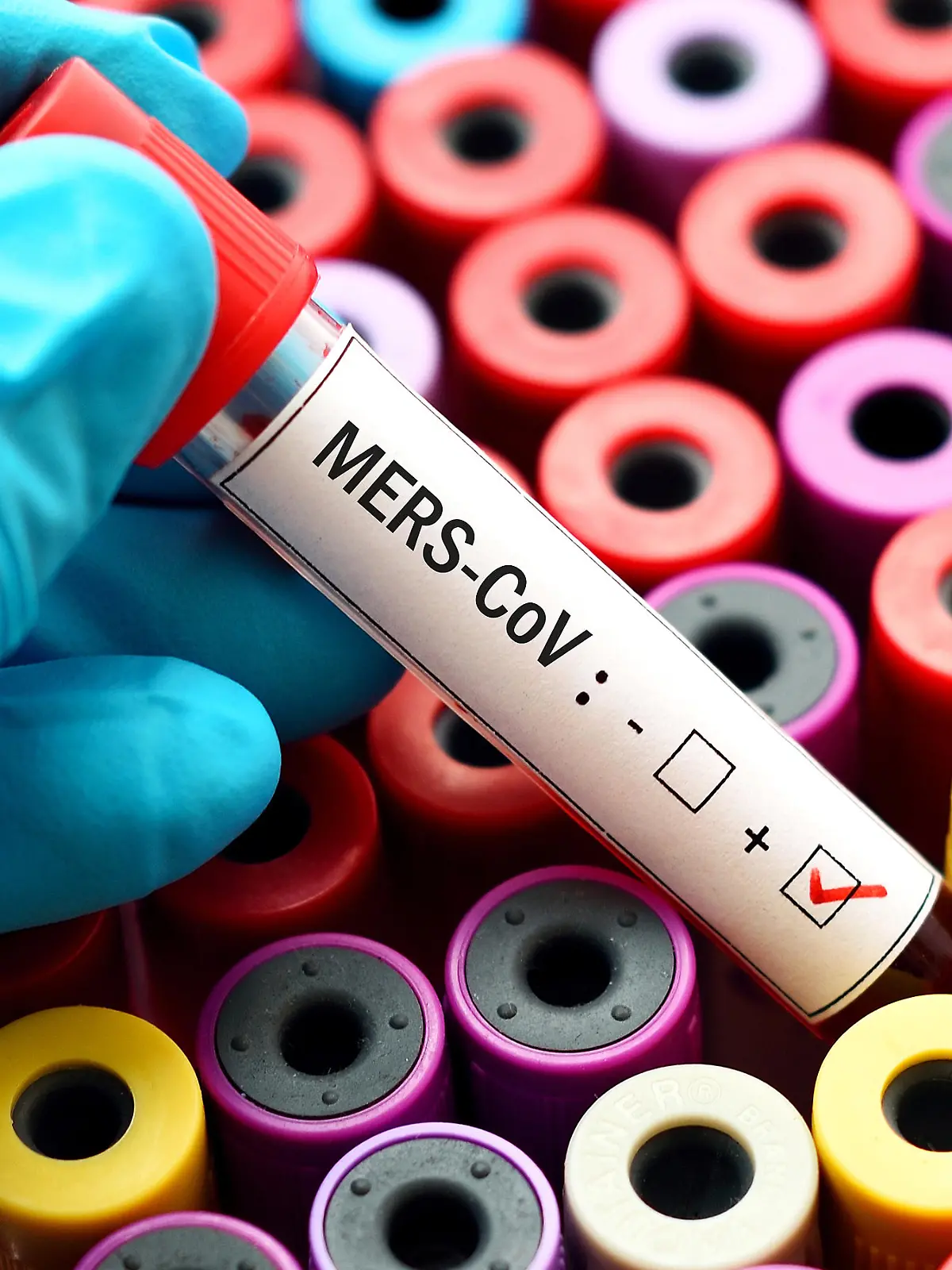 Gesundheitslexikon: MERS