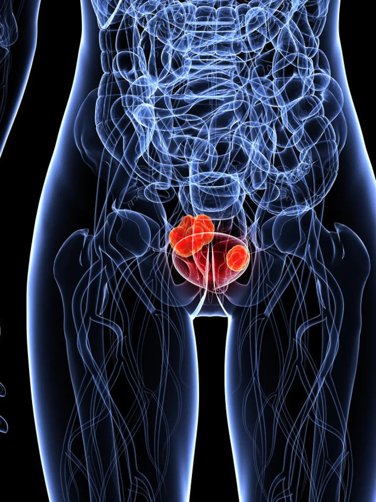 Gesundheitslexikon: Blasenkrebs ist eine Krankheit, bei der der bösartige Tumor in der Harnblase sitzt.