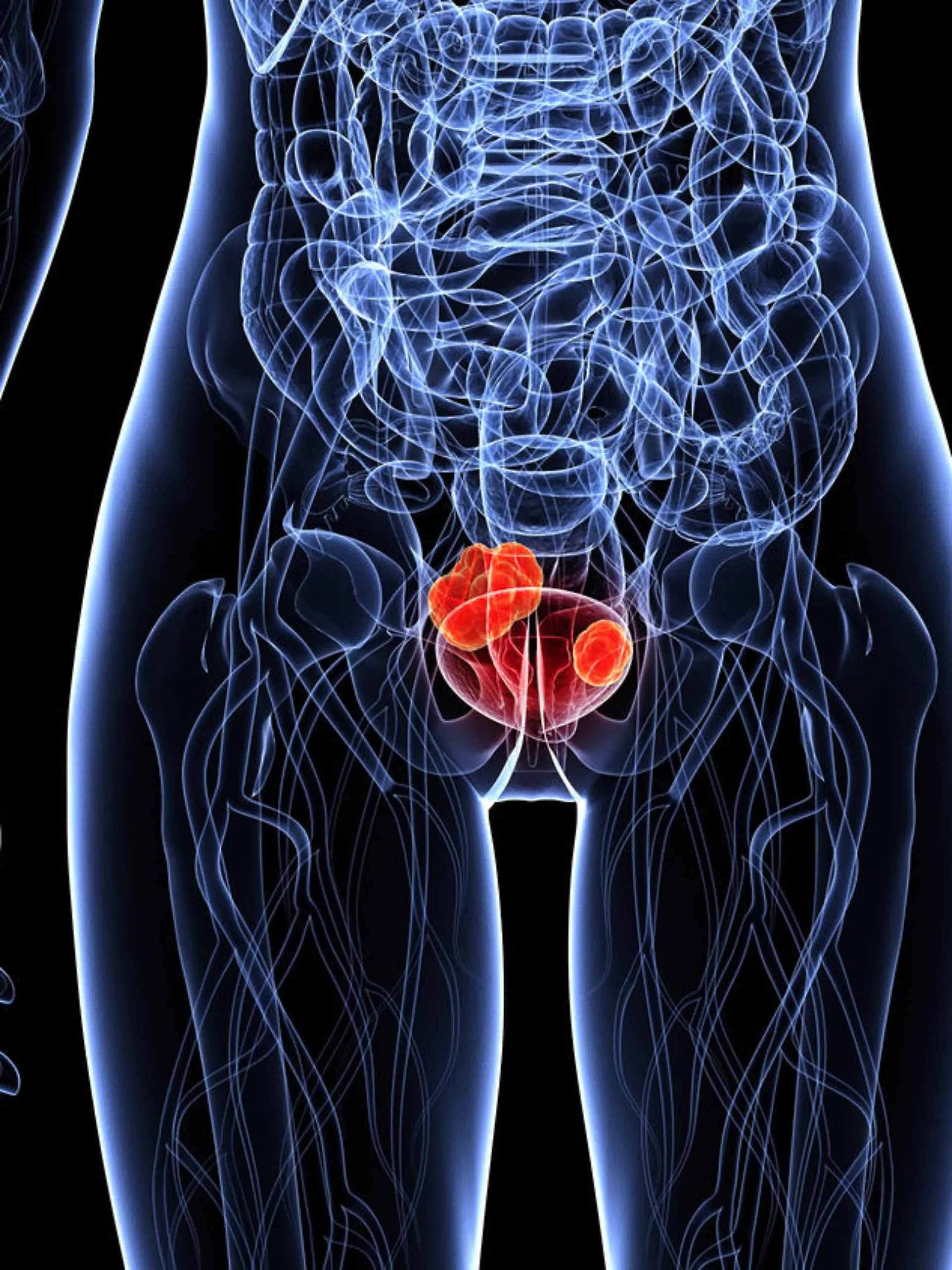 Gesundheitslexikon: Blasenkrebs ist eine Krankheit, bei der der bösartige Tumor in der Harnblase sitzt.