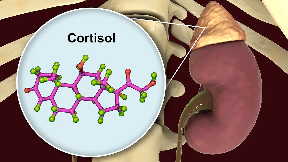 Das klinische Bild des Cushing-Syndroms ist die Folge einer krankhaft gesteigerten Produktion des Nebennierenhormons Cortisol