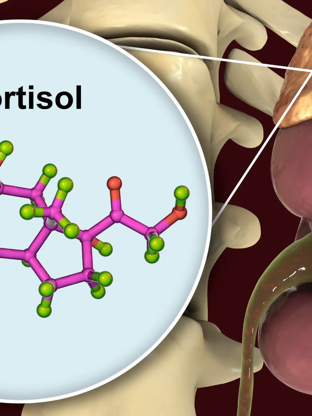 Das klinische Bild des Cushing-Syndroms ist die Folge einer krankhaft gesteigerten Produktion des Nebennierenhormons Cortisol