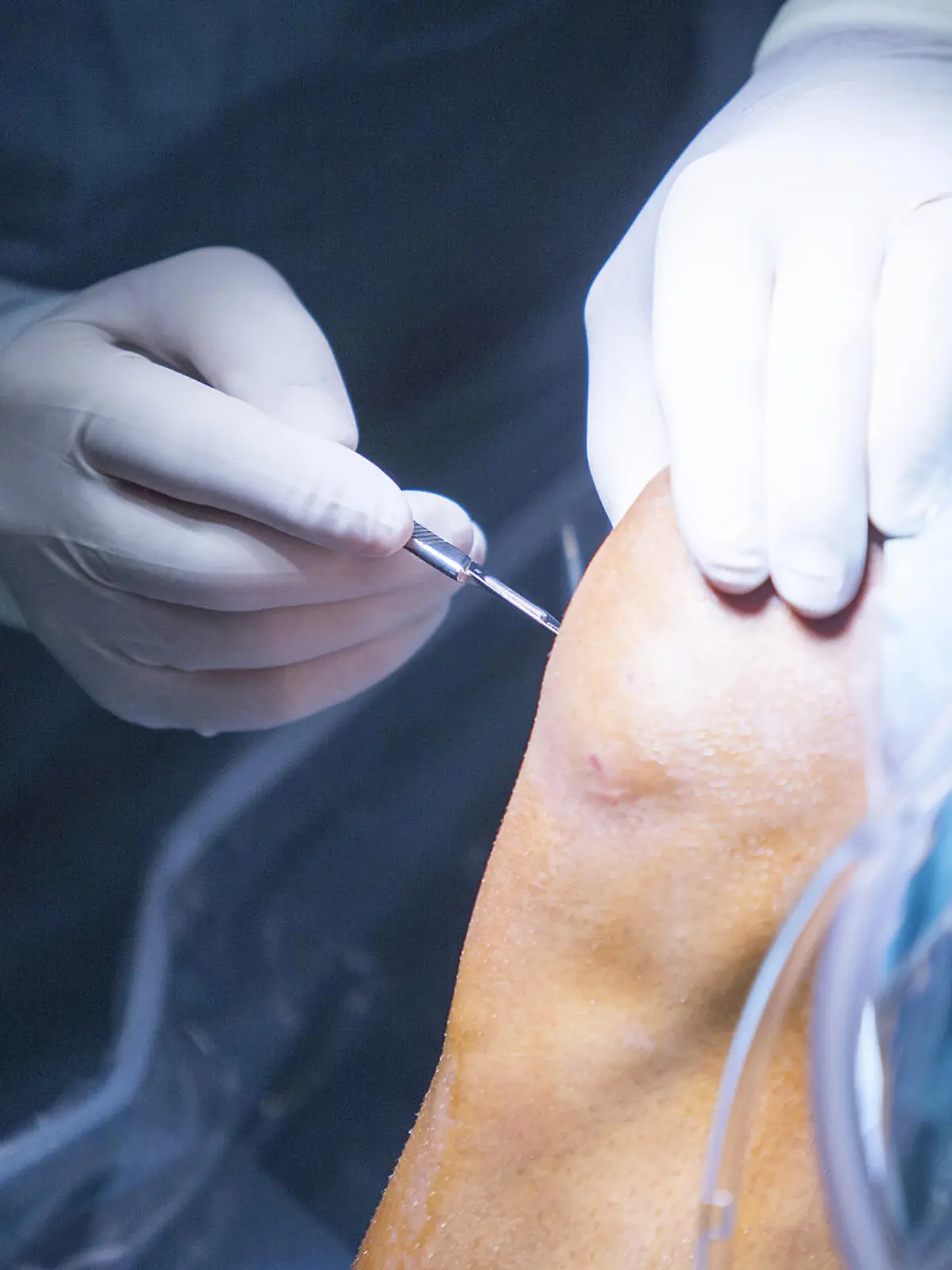 Gesundheitslexikon: Meniskusriss