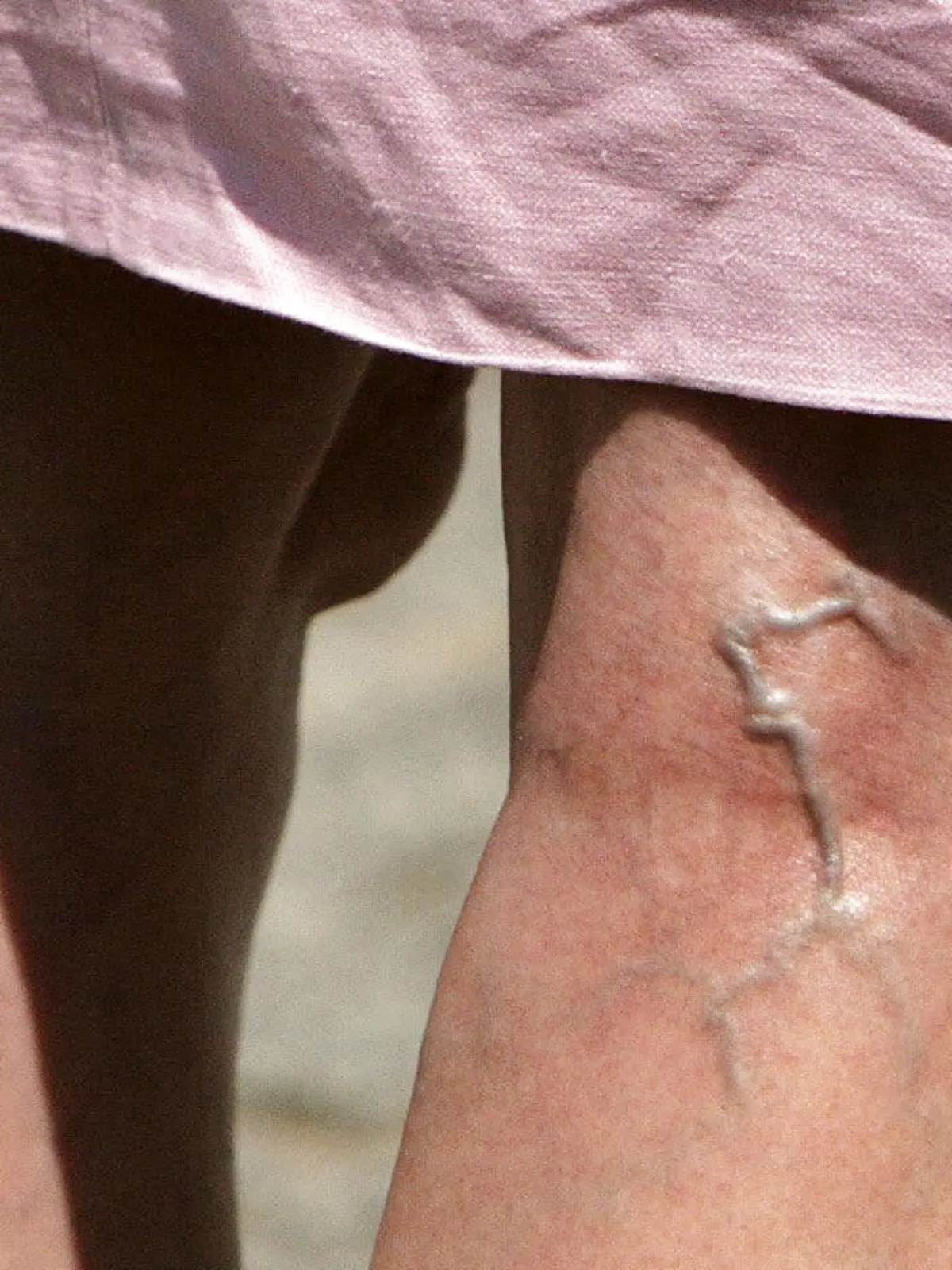 Der Blick auf die Beine einer Frau mit starken Krampfadern, aufgenommen 24.05.2007 in Berlin. Krampfadern (Varizen, Varikose) haben nichts mit "Krampf" zu tun. Der Begriff leitet sich von "Krummader" ab.Bei manchen Patienten ziehen sich die "krummen Adern" als Knötchen und Stränge über die Beine. Das, was die Betroffenen nicht nur aus kosmetischer Sicht stört, sondern auch ganz handfeste, nicht zu unterschätzende Beschwerden bereitet, sind erweiterte Venen. Normalerweise transportieren die Beinvenen das Blut zum Herzen. Sie umgehen dabei die Gesetze der Schwerkraft ± Venenklappen sorgen dafür, dass das Blut nicht immer wieder nach unten sackt. Muskelbewegungen üben auf die Venenwände Druck aus und sorgen so für den Transport nach oben. Schließen die Venenklappen jedoch nicht mehr richtig, kommt es zu einem Rückstau des Blutes und die Venen erweitern sich und treten dann ± vor allem an den Beinen ± dick hervor. Foto: Arno Burgi  +++(c) dpa - Report+++