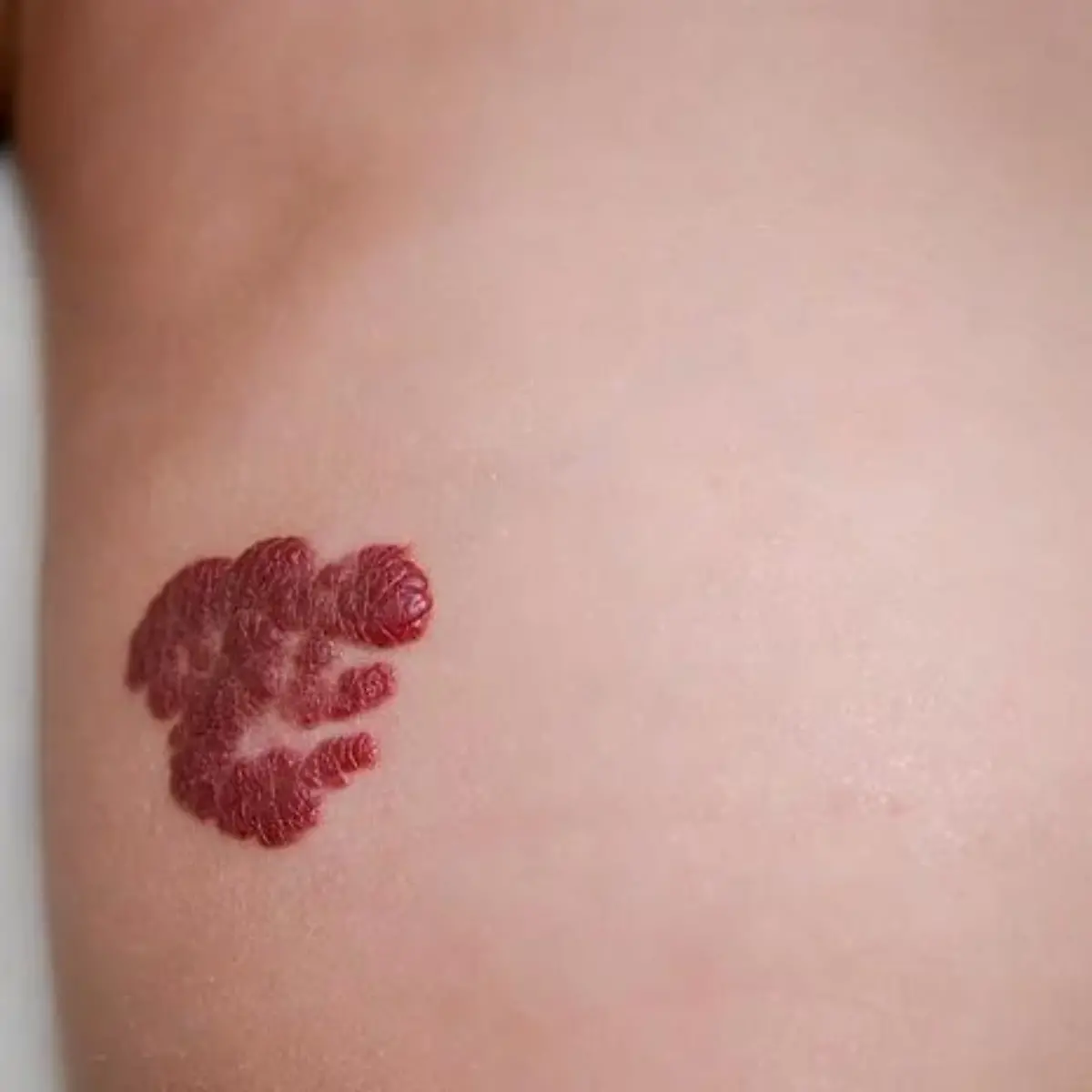 Hämangiom (Blutschwämmchen) Logo von Hämangiom (Blutschwämmchen)