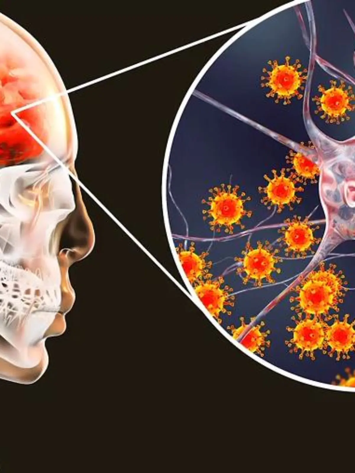 Bild zu: "Enzephalitis (Gehirnentzündung)"