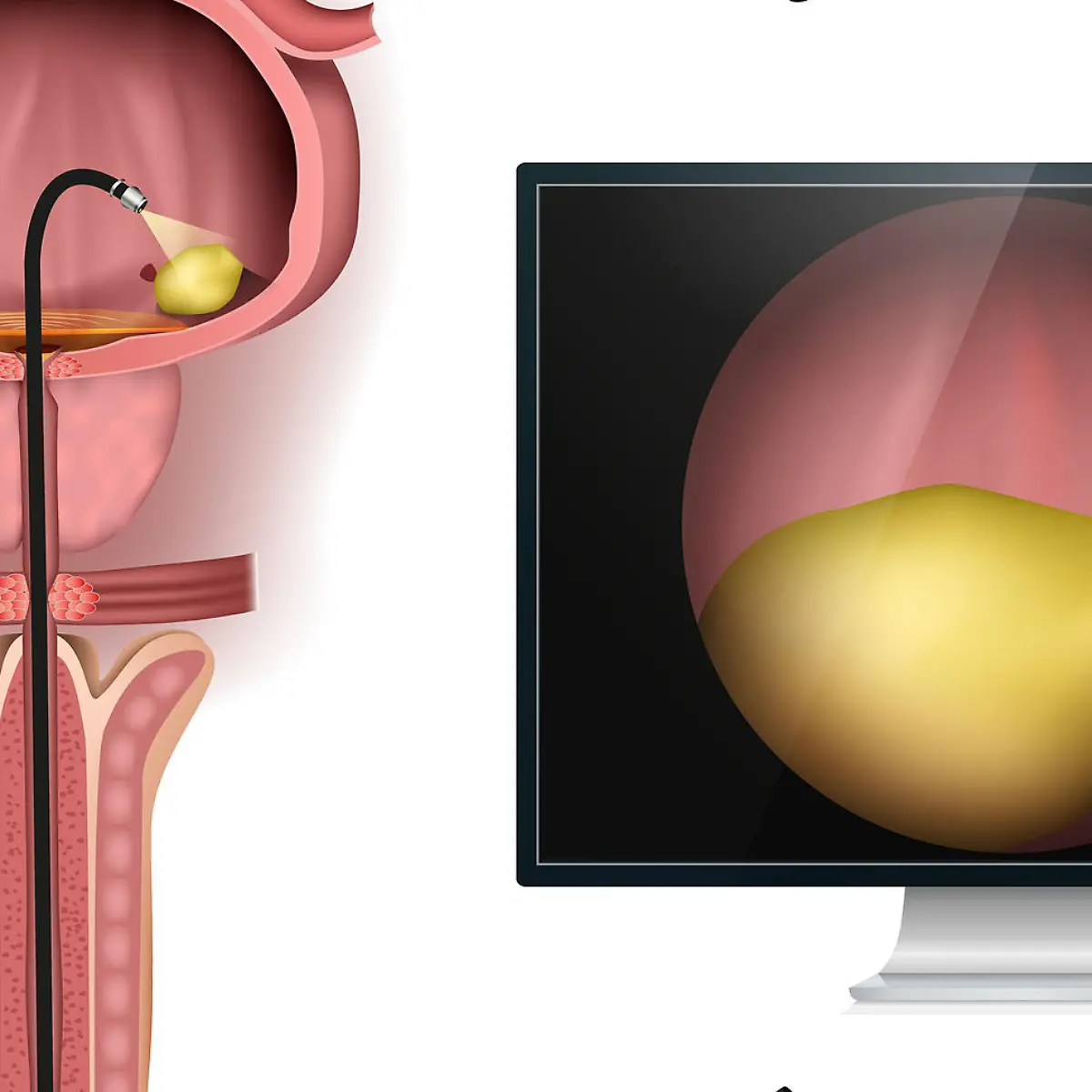 Zystoskopie (Blasenspiegelung) Logo von Zystoskopie (Blasenspiegelung)
