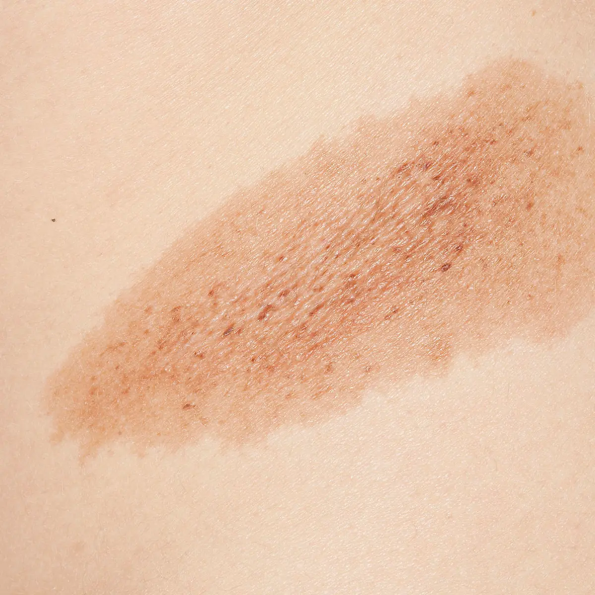 Hyperpigmentierung (Chloasma, Melasma) Logo von Hyperpigmentierung (Chloasma, Melasma)