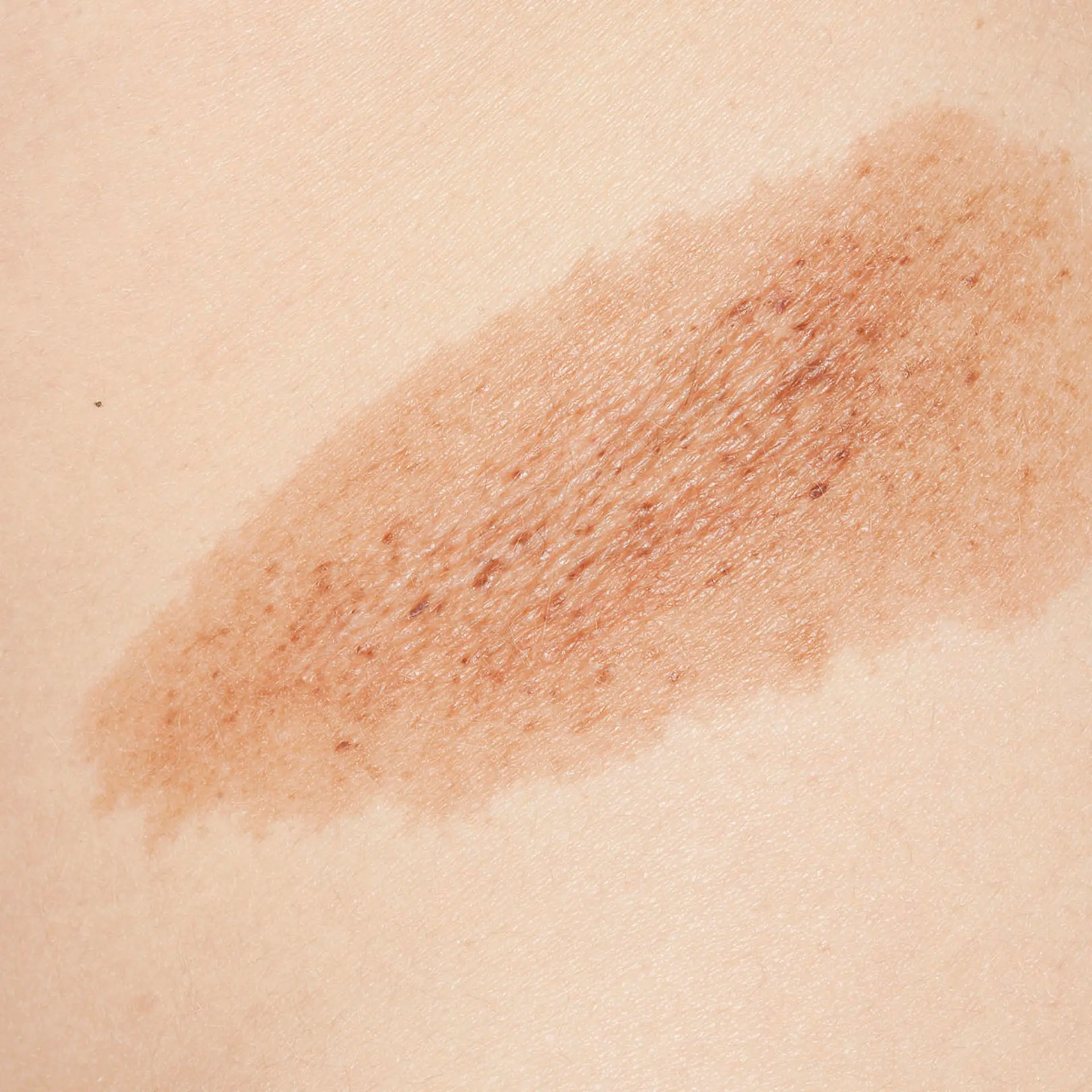 Hyperpigmentierung (Chloasma, Melasma) Logo von Hyperpigmentierung (Chloasma, Melasma)