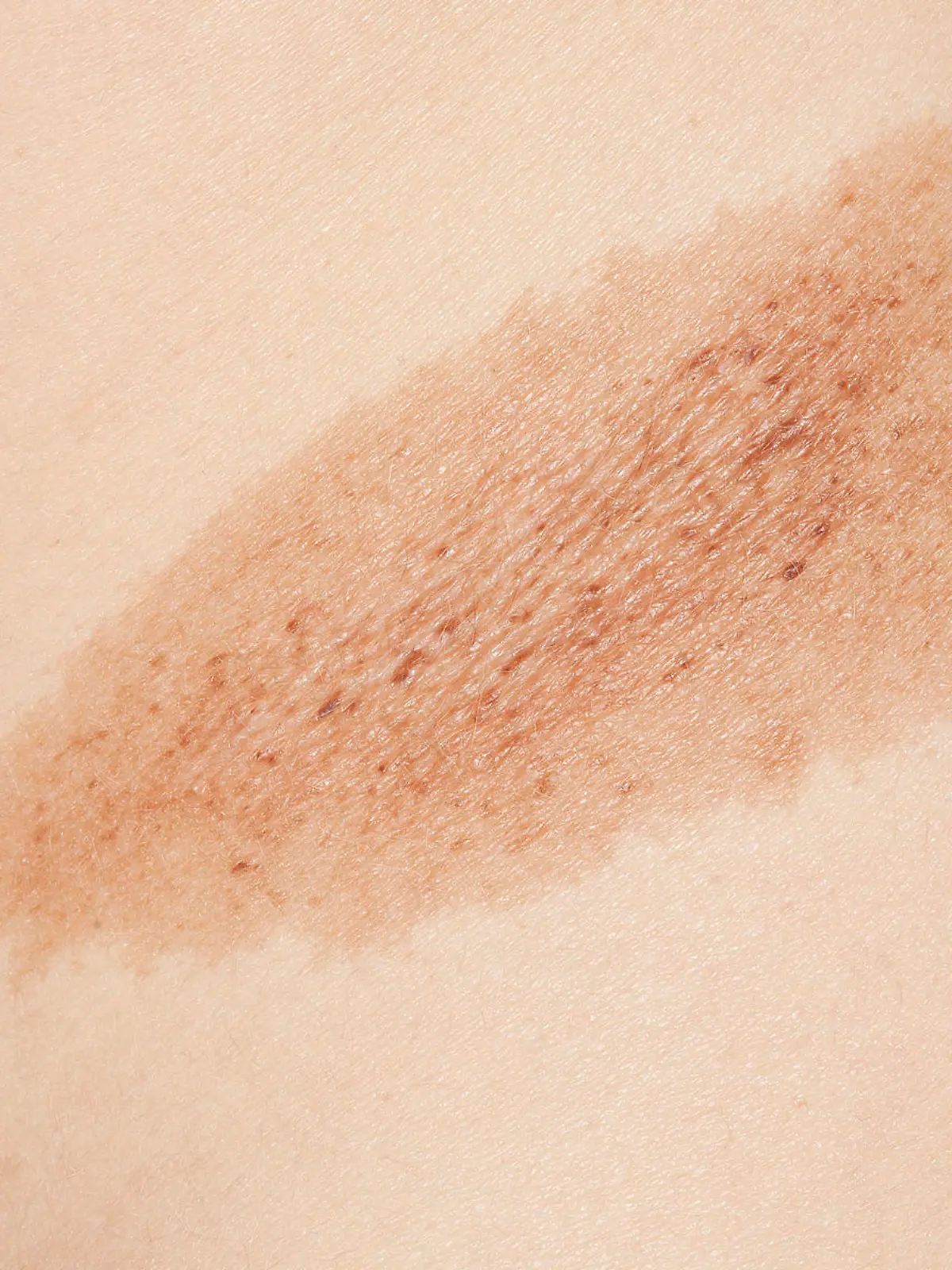 Gesundheitslexikon: Hyperpigmentierung