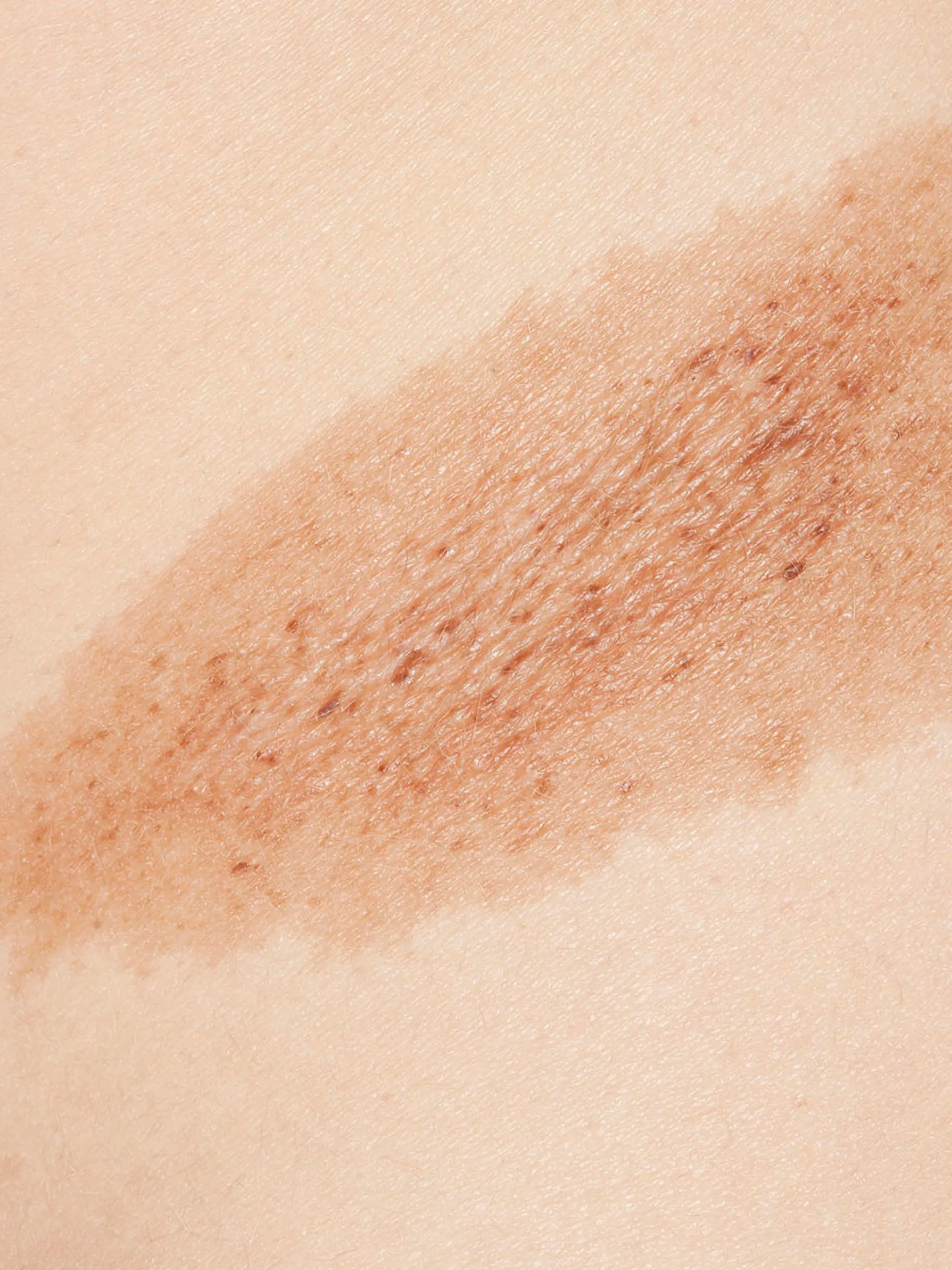 Gesundheitslexikon: Hyperpigmentierung