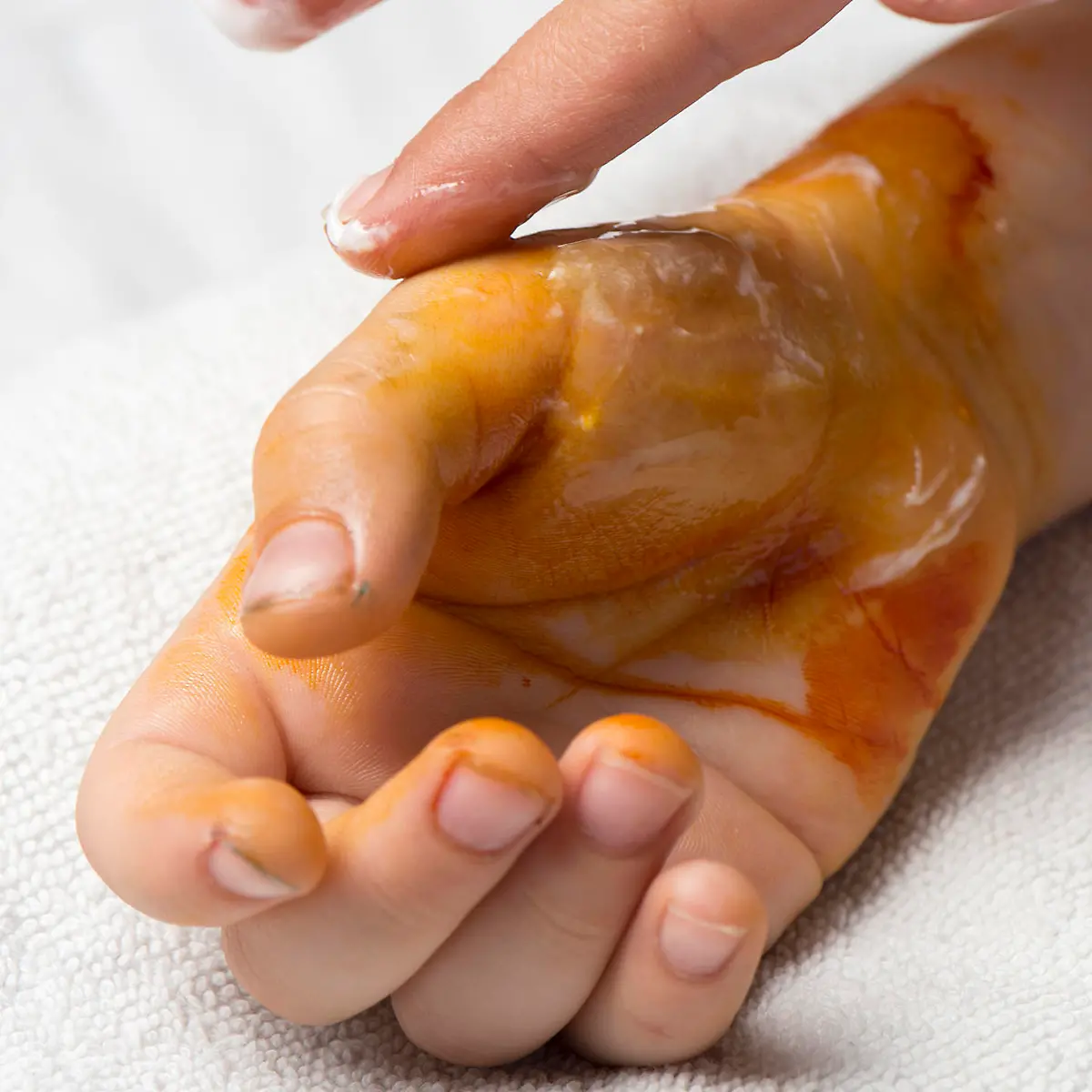 Verbrennung (Brandverletzung) Logo von Verbrennung (Brandverletzung)