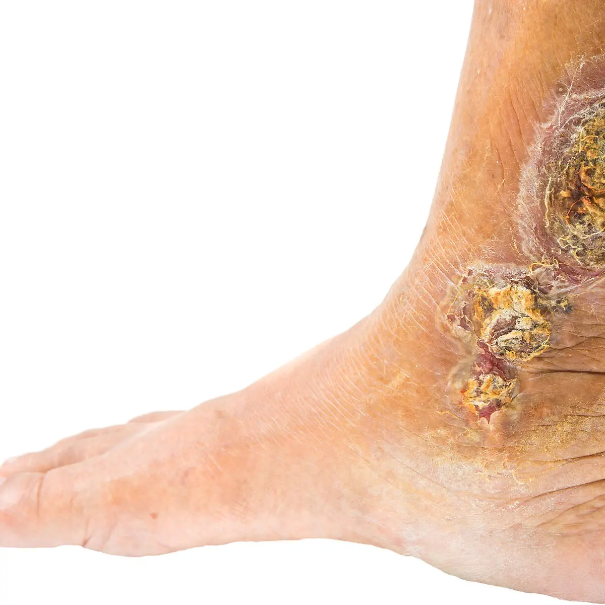 Ulcus cruris (Unterschenkelgeschwür) Logo von Ulcus cruris (Unterschenkelgeschwür)